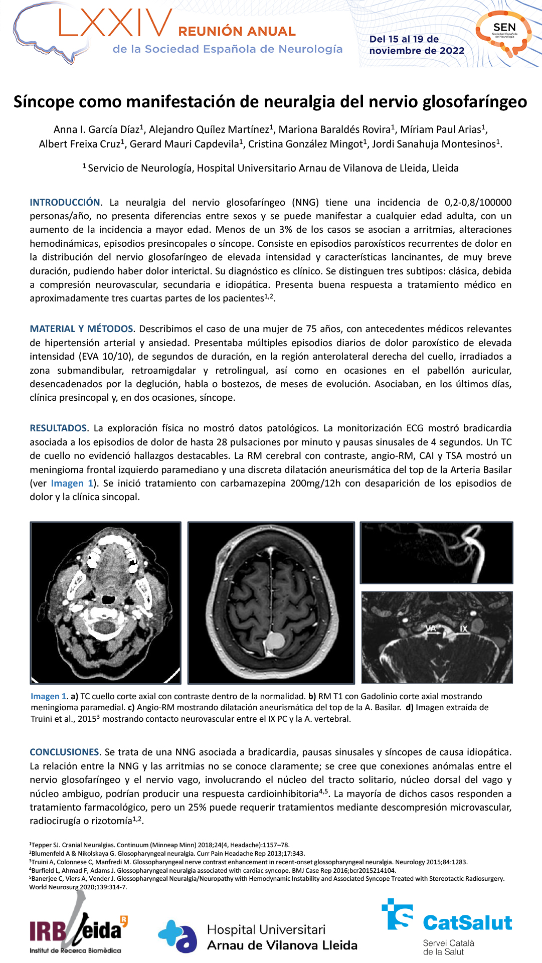 Síncopes como manifestación de neuralgia del nervio glosofaríngeo