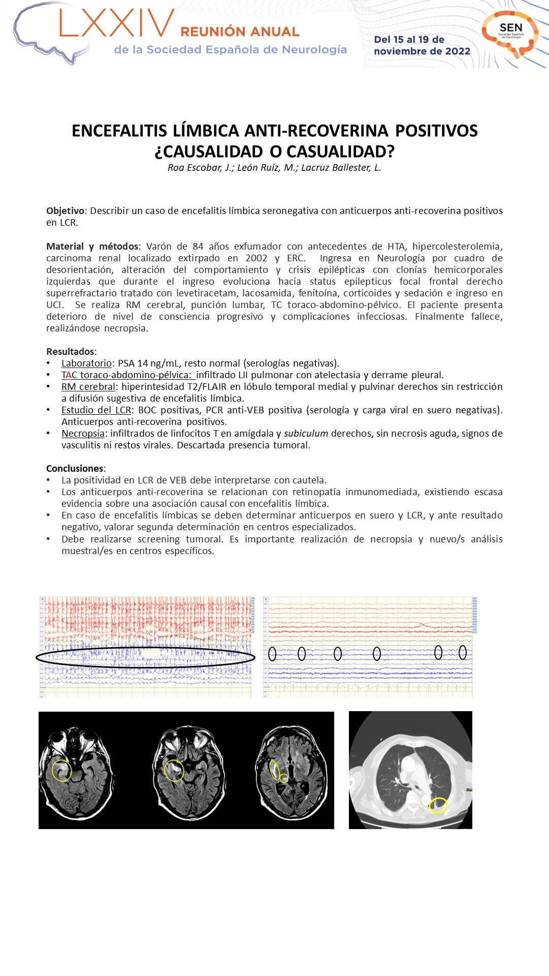 Encefalitis límbica anti-recoverina positivos ¿causalidad o casualidad?