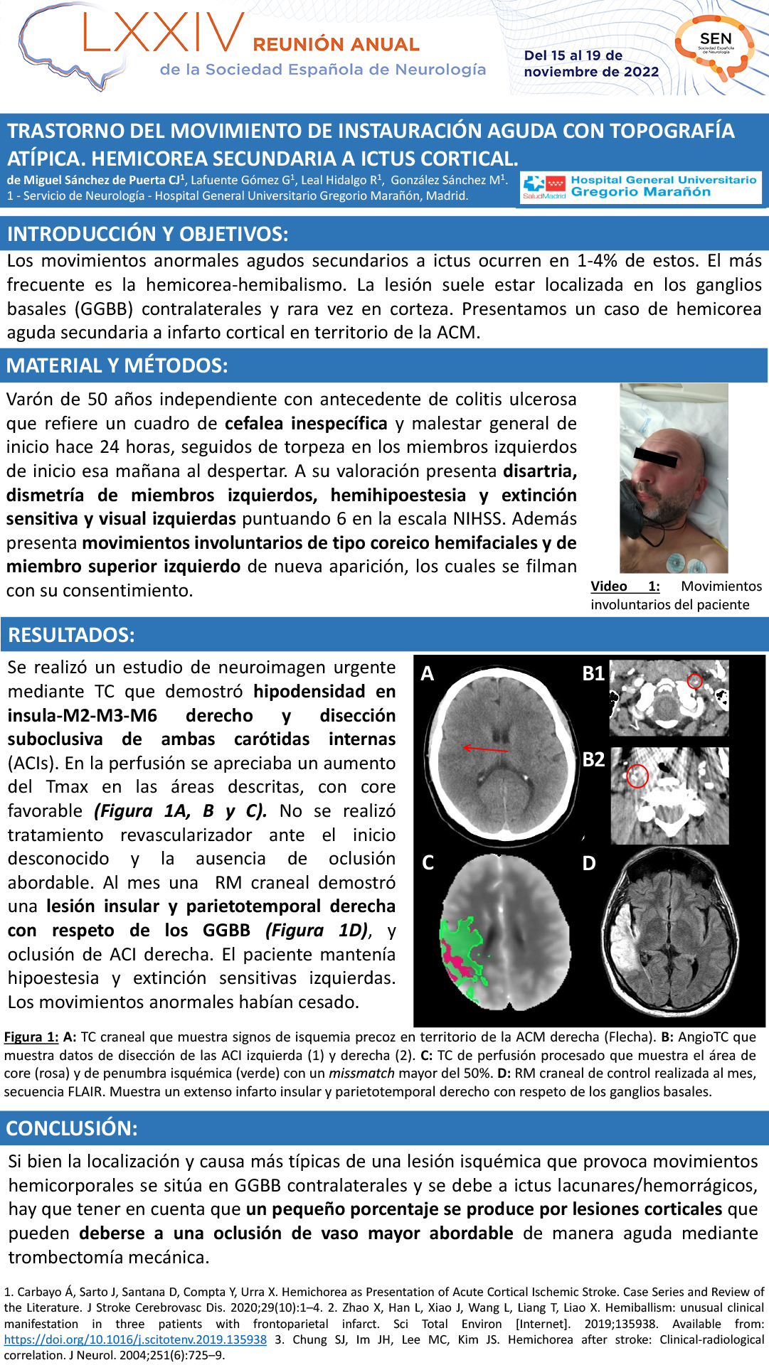 Trastorno agudo del movimiento con topografía atípica. Hemicorea aguda secundaria a ictus cortical