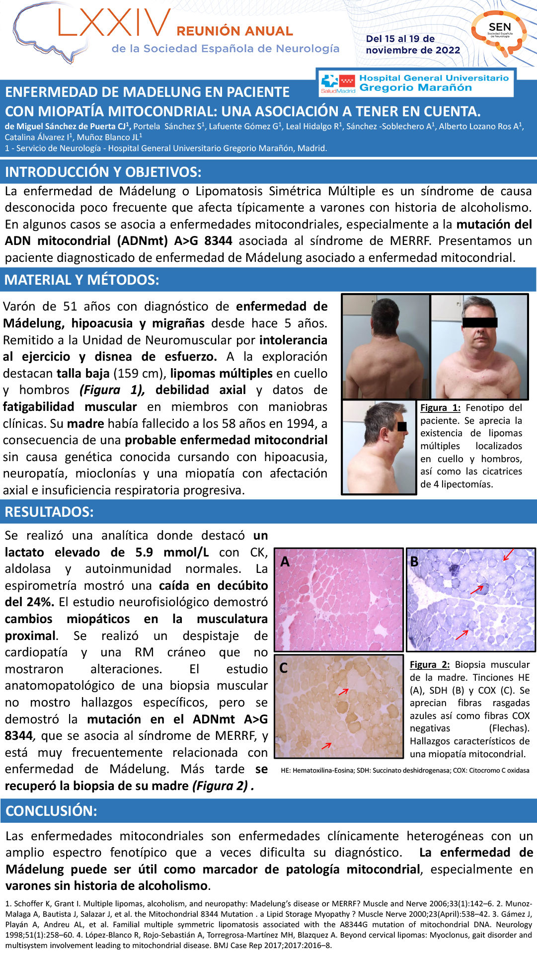 Enfermedad de Madelung en paciente con miopatía mitocondrial: una asociación a tener en cuenta.