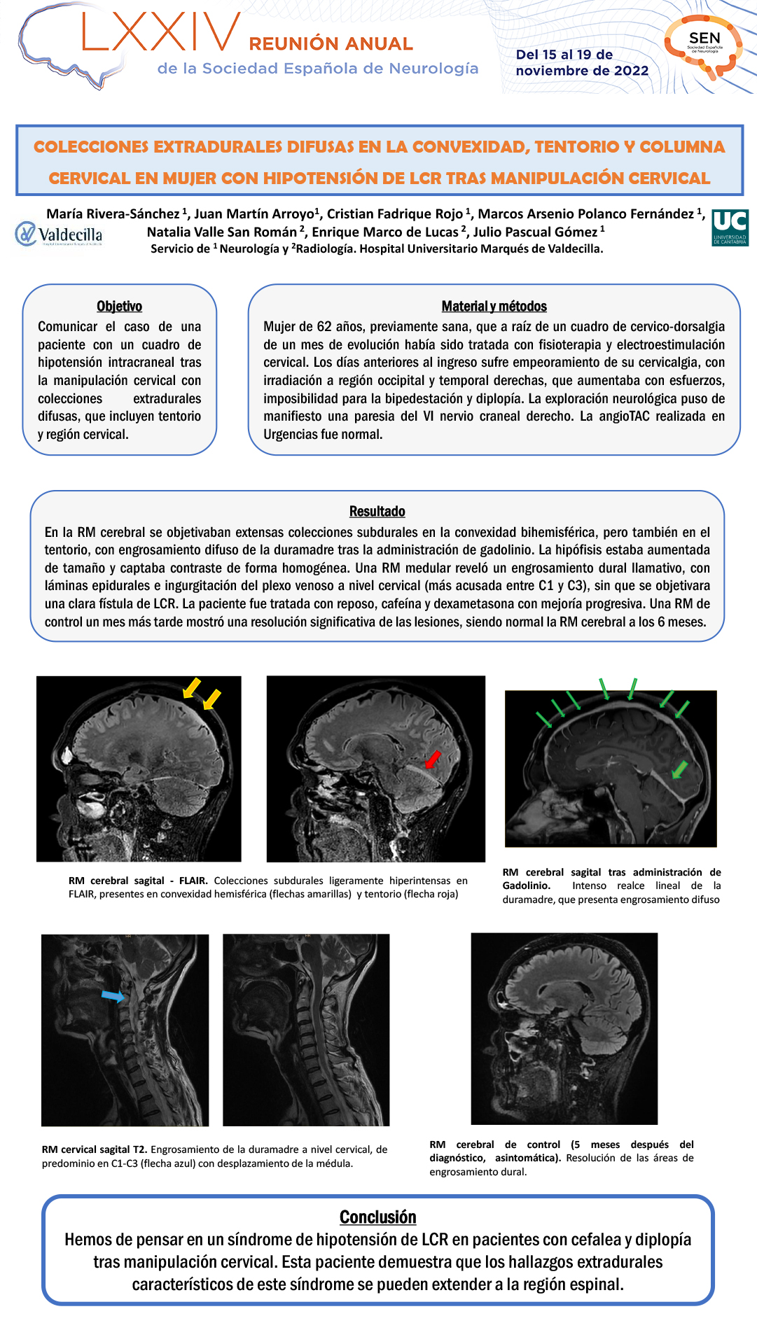 Colecciones extradurales difusas en la convexidad, tentorio y columna cervical en mujer con hipotensión de LCR tras manipulación cervical