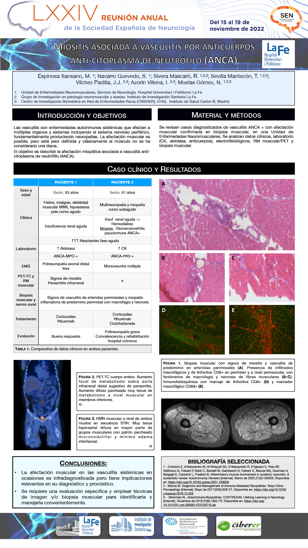 Miositis asociada a vasculitis por anticuerpos anti-citoplasma de neutrófilo (ANCA)