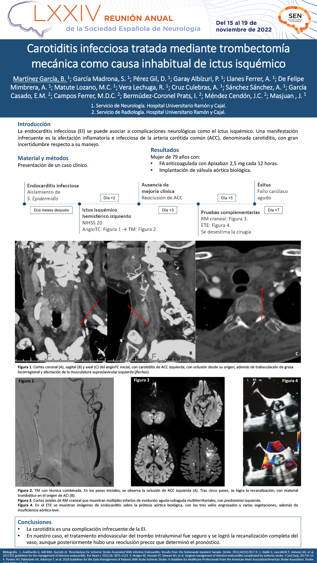 Carotiditis infecciosa tratada mediante trombectomía mecánica como causa inhabitual de ictus isquémico