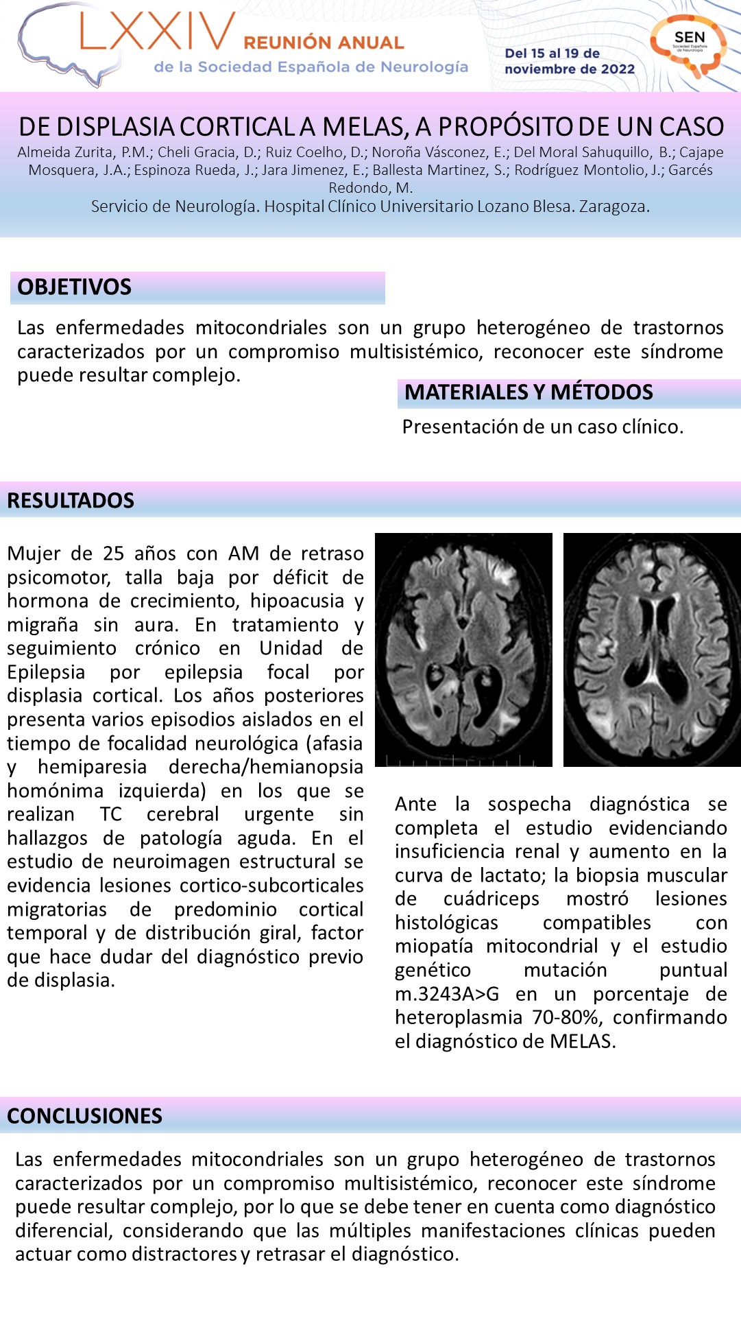 De displasia cortical a MELAS, a propósito de un caso