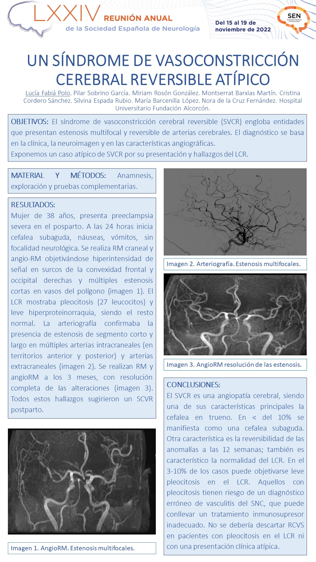 Un síndrome de vasoconstricción cerebral reversible atípico
