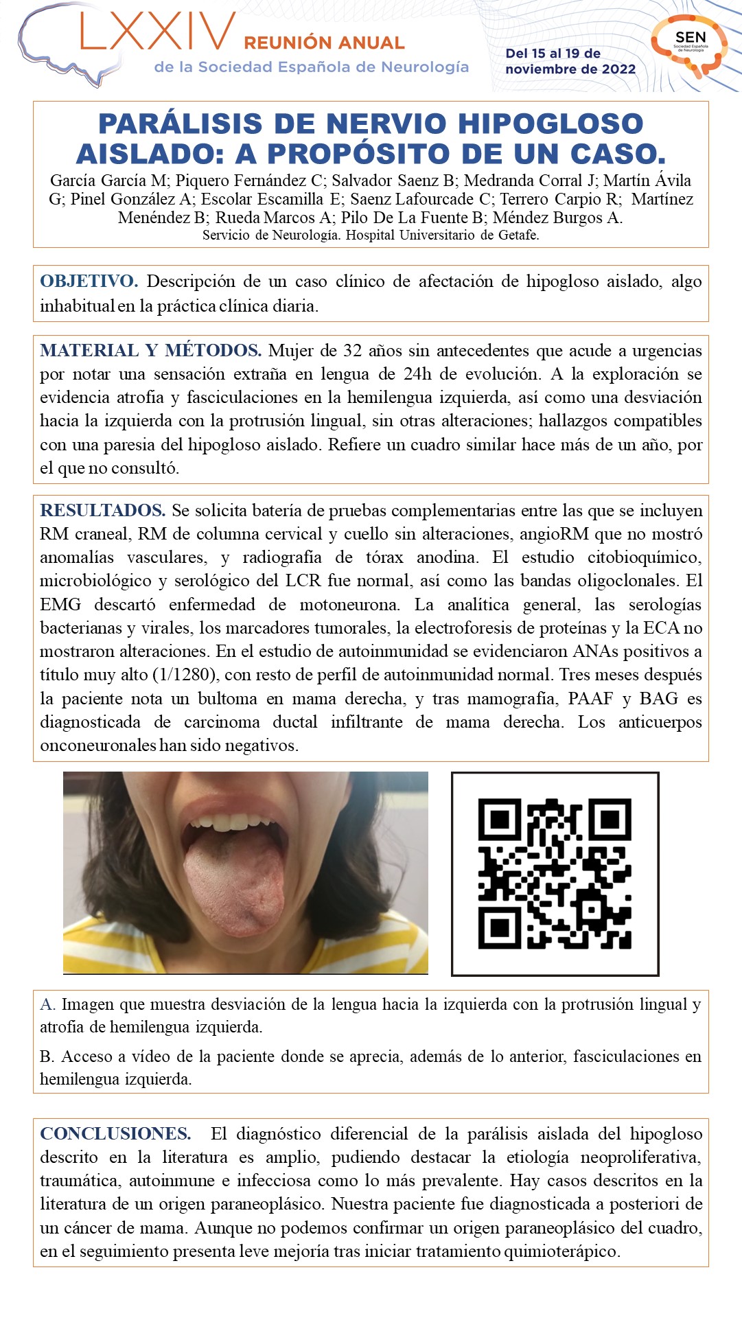 Sin irse de la lengua. Parálisis de nervio hipogloso aislado: a propósito de un caso