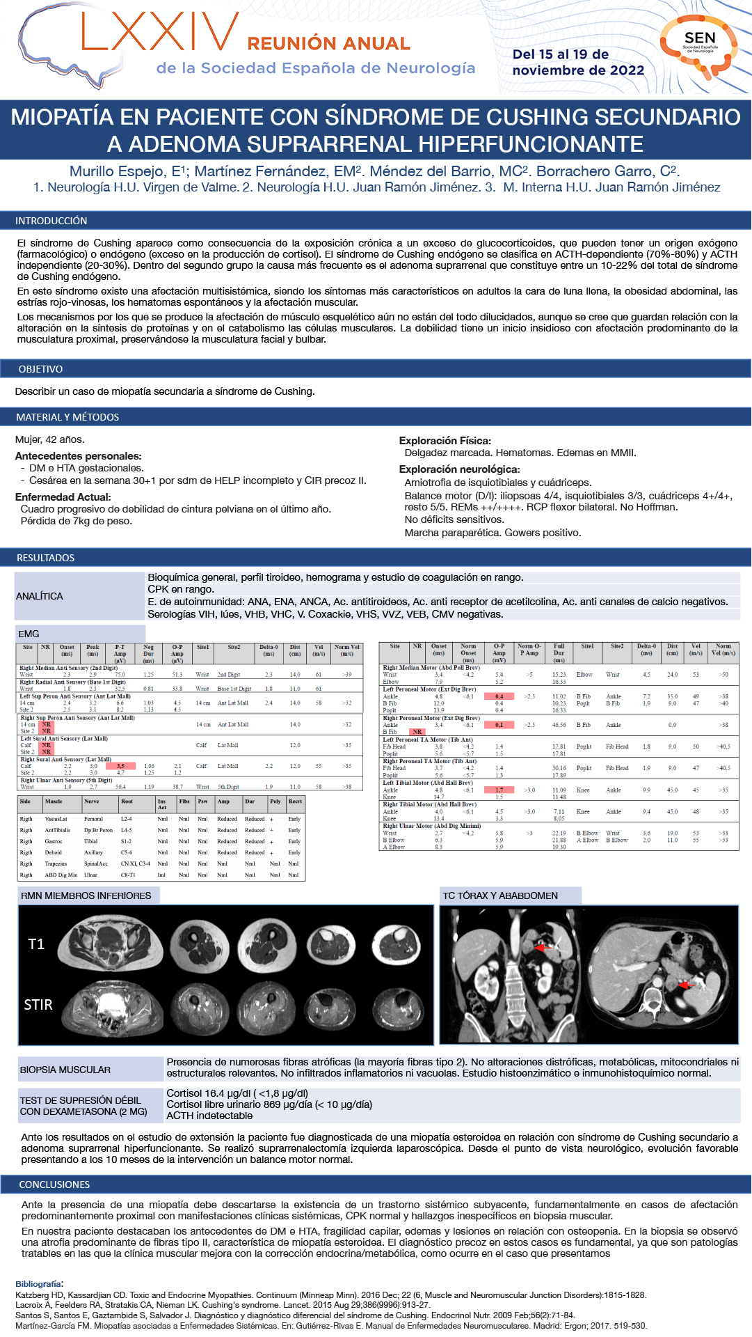 Miopatía en paciente con síndrome de Cushing (SC) secundario a adenoma suprarrenal hiperfuncionante