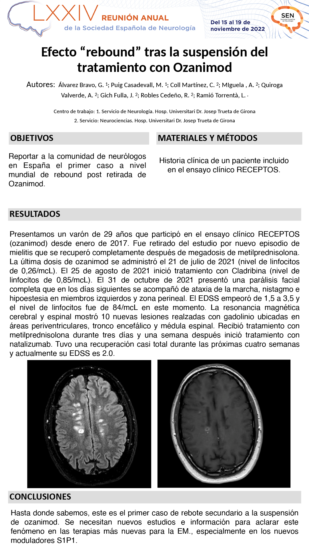Efecto rebote tras la suspensión de Ozanimod