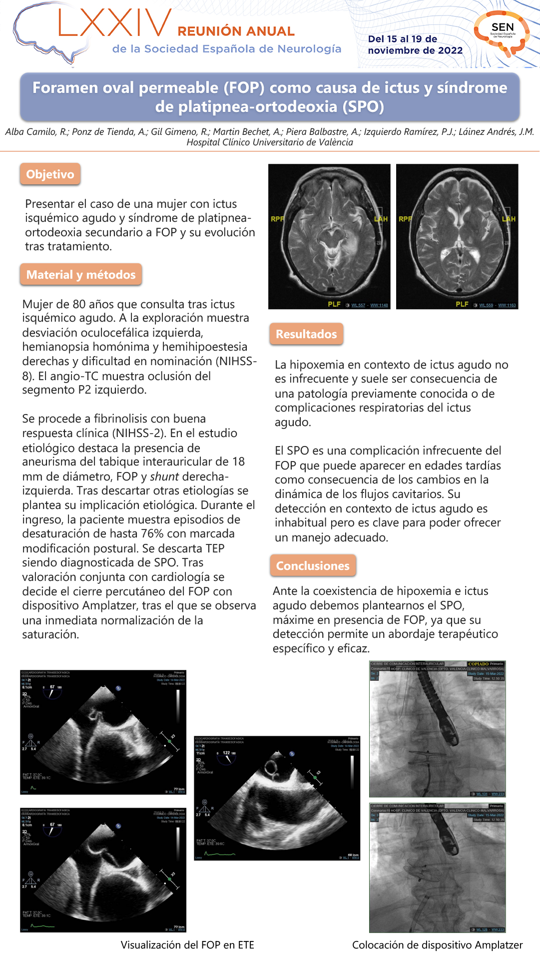 Foramen oval permeable (FOP) como causa de ictus y síndrome de platipnea-ortodeoxia (SPO)