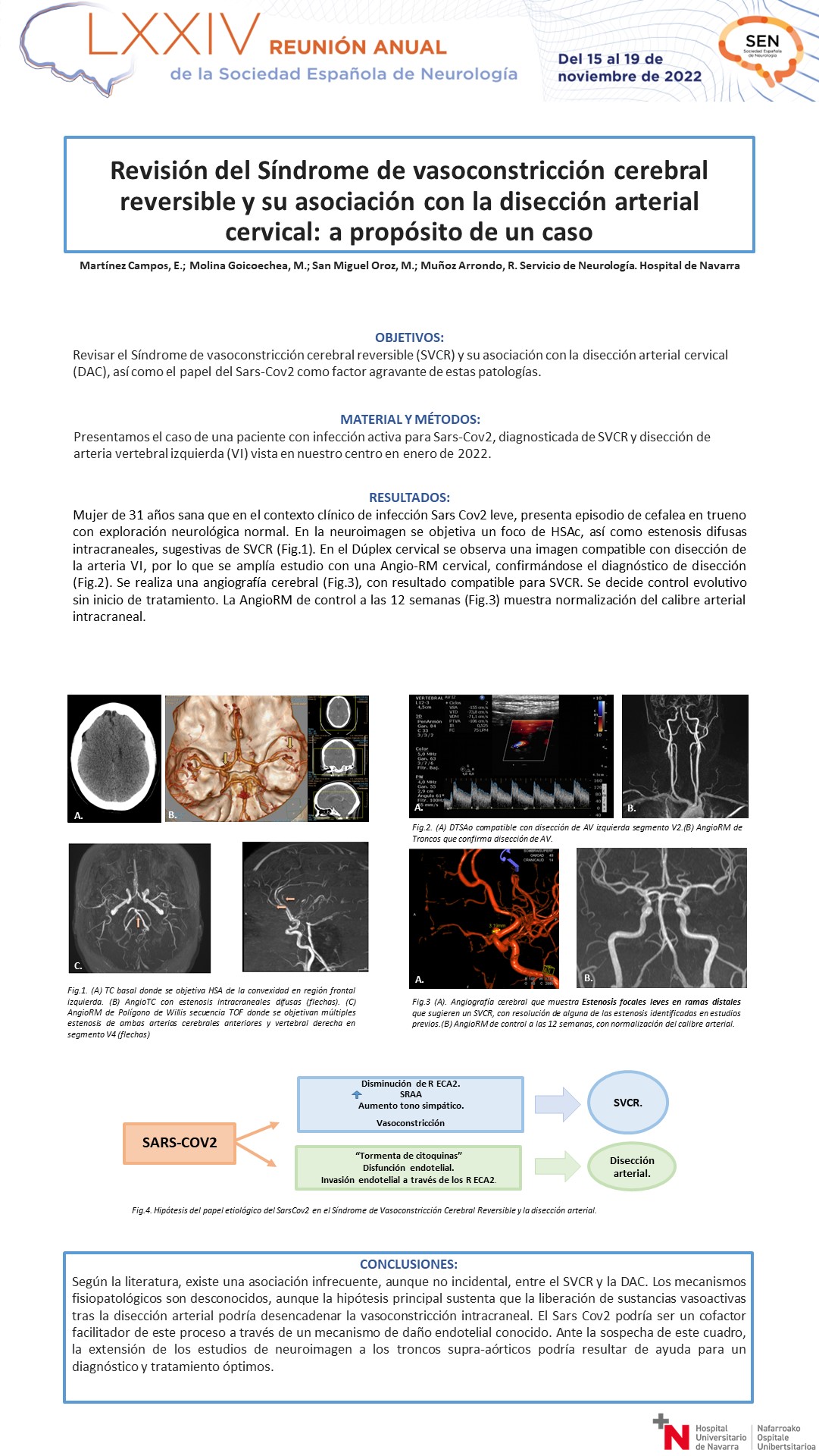 Revisión del Síndrome de vasoconstricción cerebral reversible y su asociación con la disección arterial cervical: a propósito de un caso