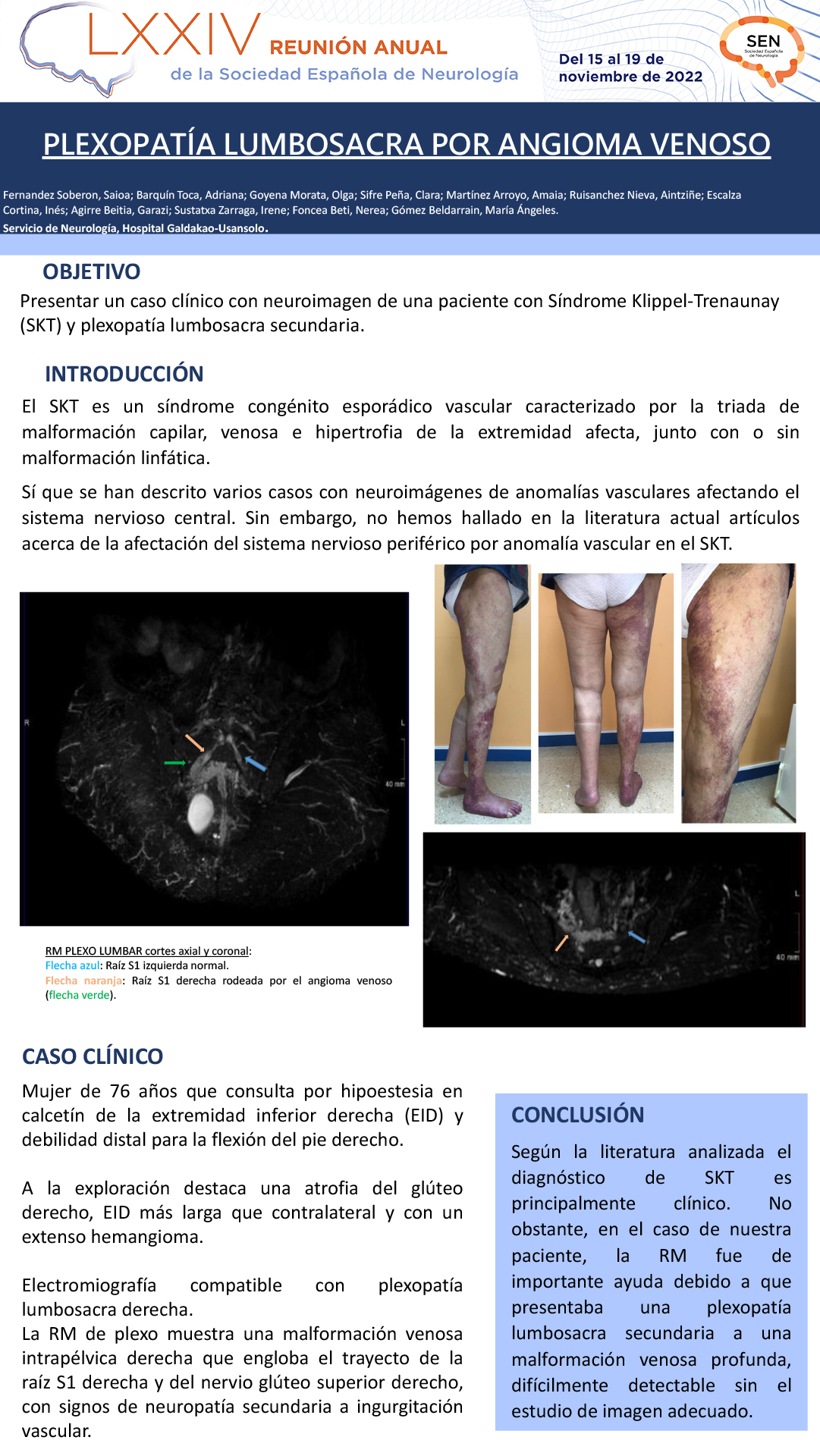 Plexopatía lumbosacra por angioma venoso