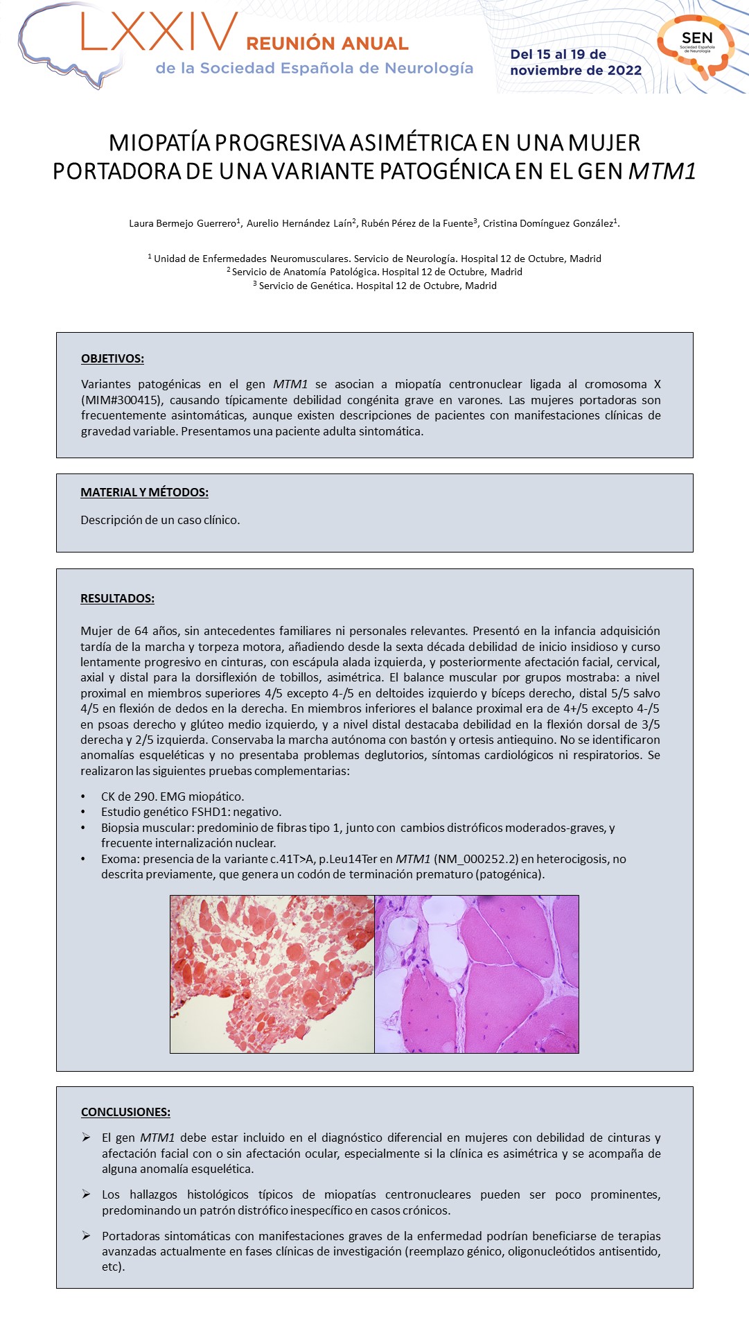 Miopatía progresiva asimétrica en una mujer portadora de una variante patogénica en el gen MTM1