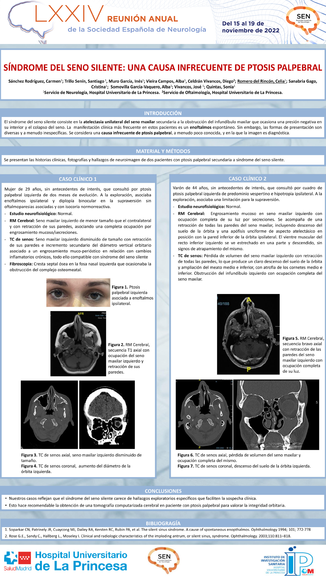 Síndrome del seno silente: una causa infrecuente de ptosis palpebral