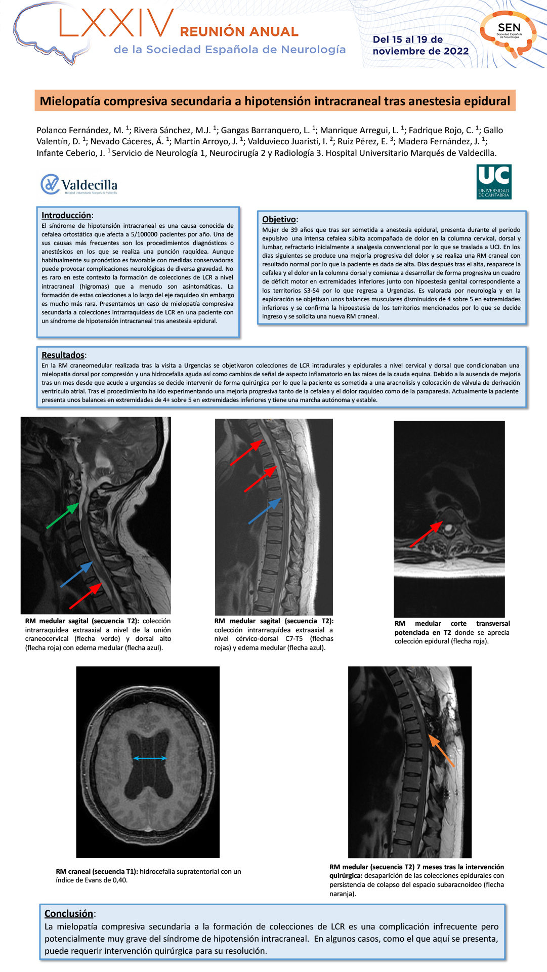 Mielopatía compresiva secundaria a hipotensión intracraneal tras anestesia epidural