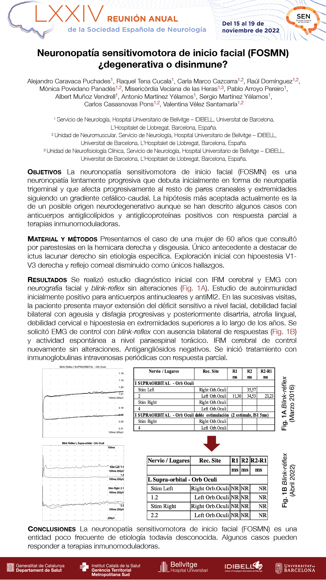 Neuronopatía sensitivomotora de inicio facial (FOSMN), ¿degenerativa o disinmune?