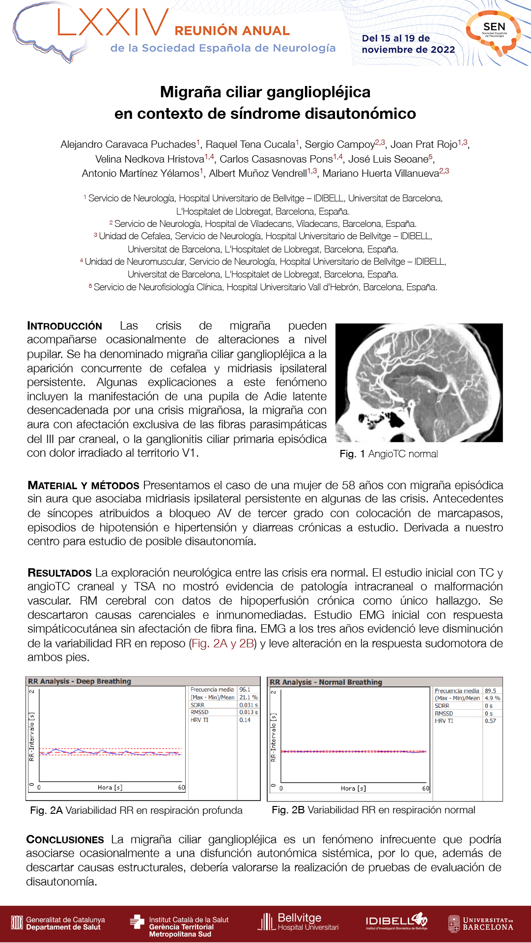 Migraña ciliar gangliopléjica en contexto de‬ síndrome disautonómico