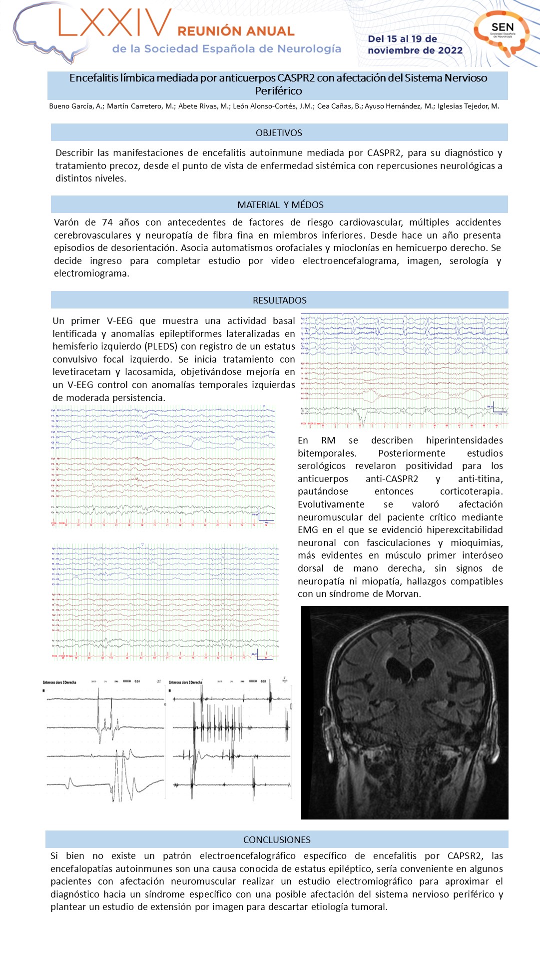 Encefalitis límbica mediada por anticuerpos CASPR2 con afectación del sistema nervioso periférico