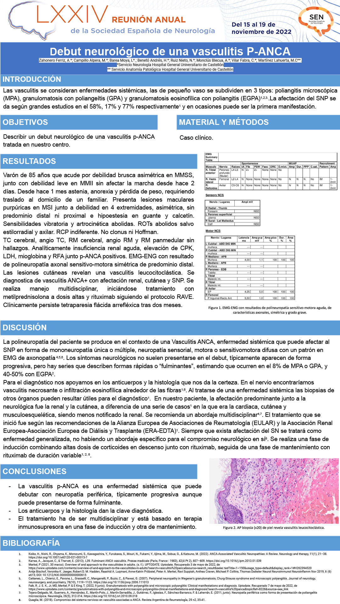 Debut neurológico de una vasculitis P-ANCA