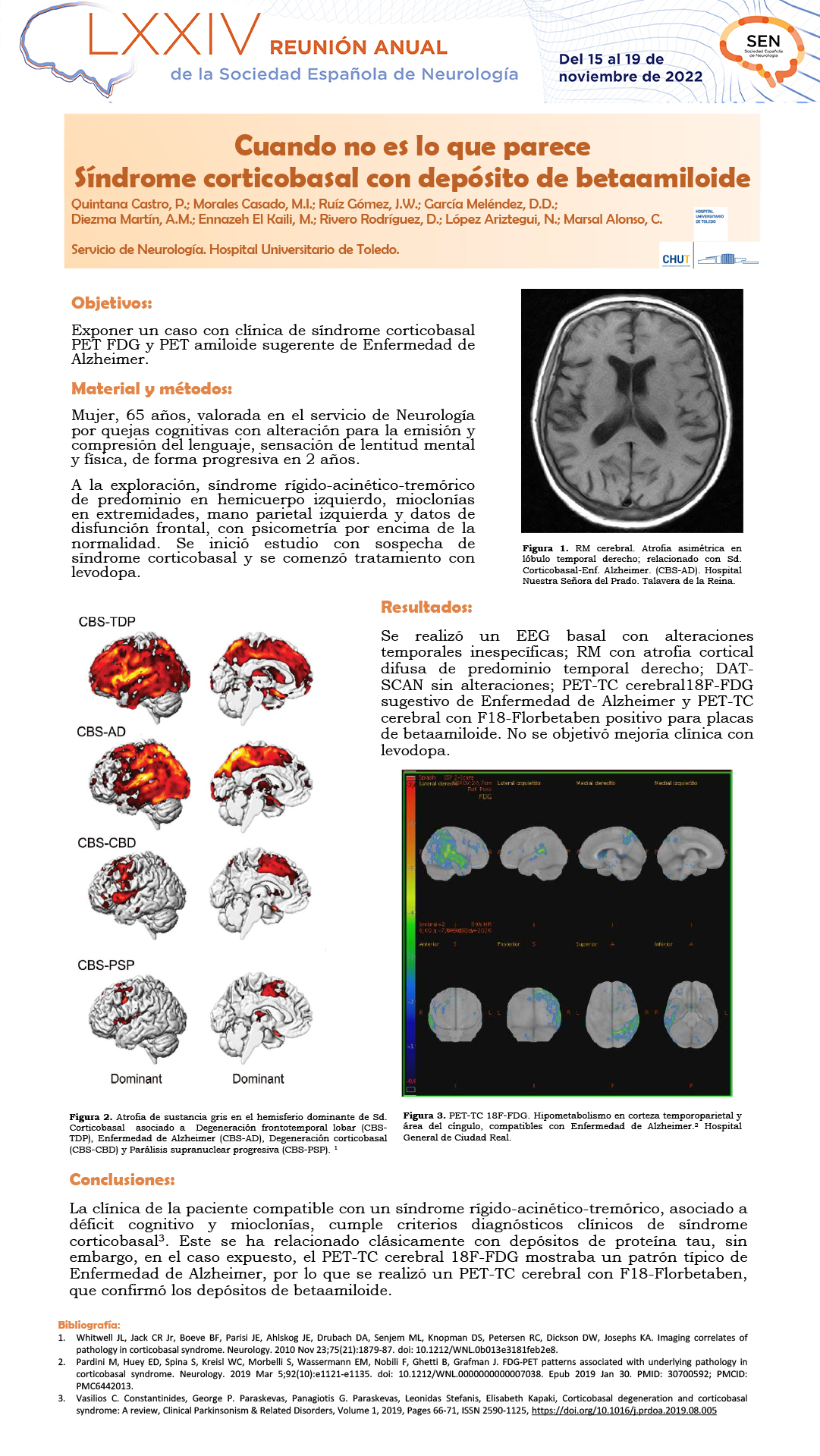 Cuando no es lo que parece. Síndrome corticobasal con depósito de betaamiloide