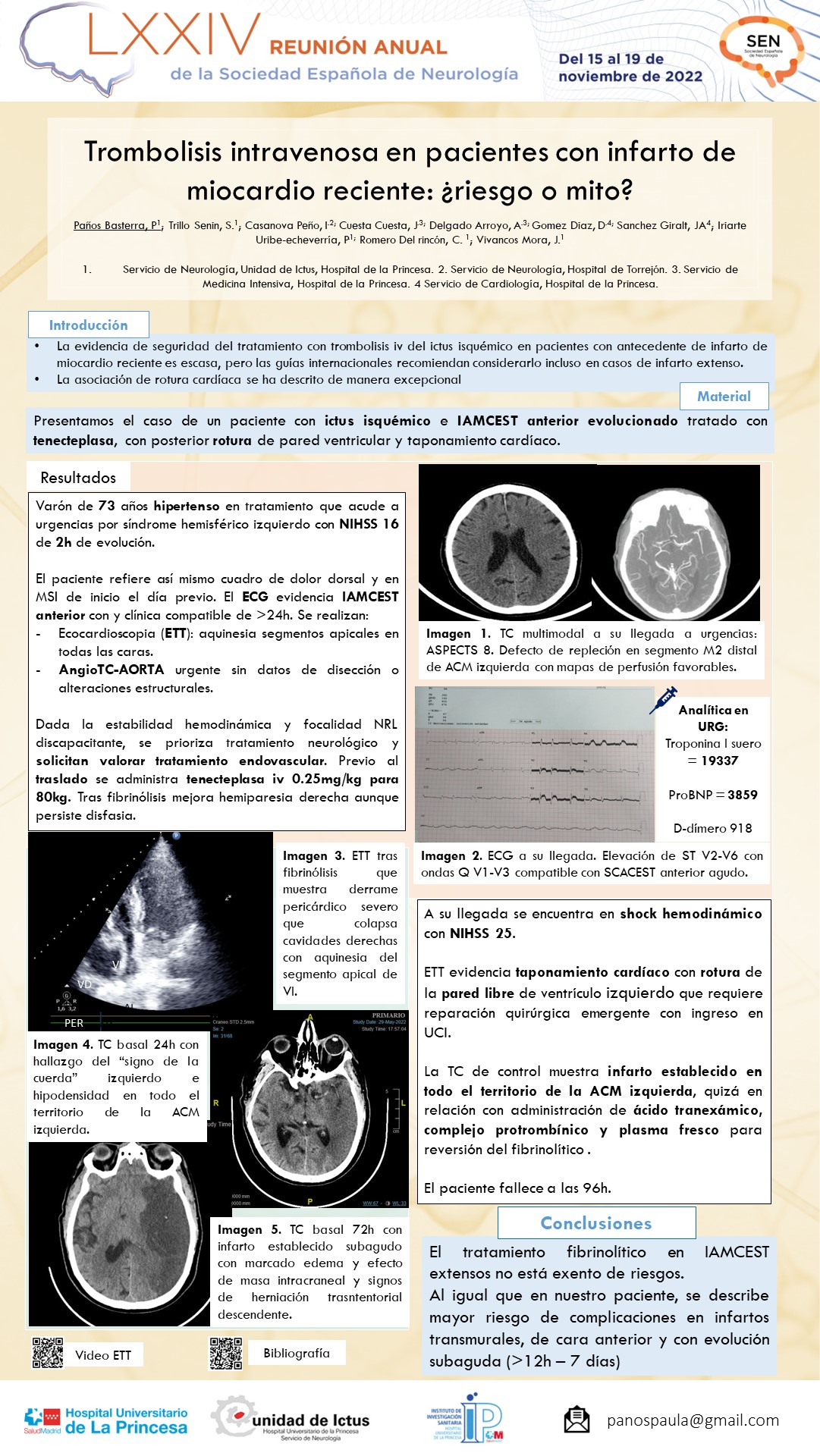 Trombolisis intravenosa en pacientes con infarto de miocardio reciente ¿riesgo o mito?