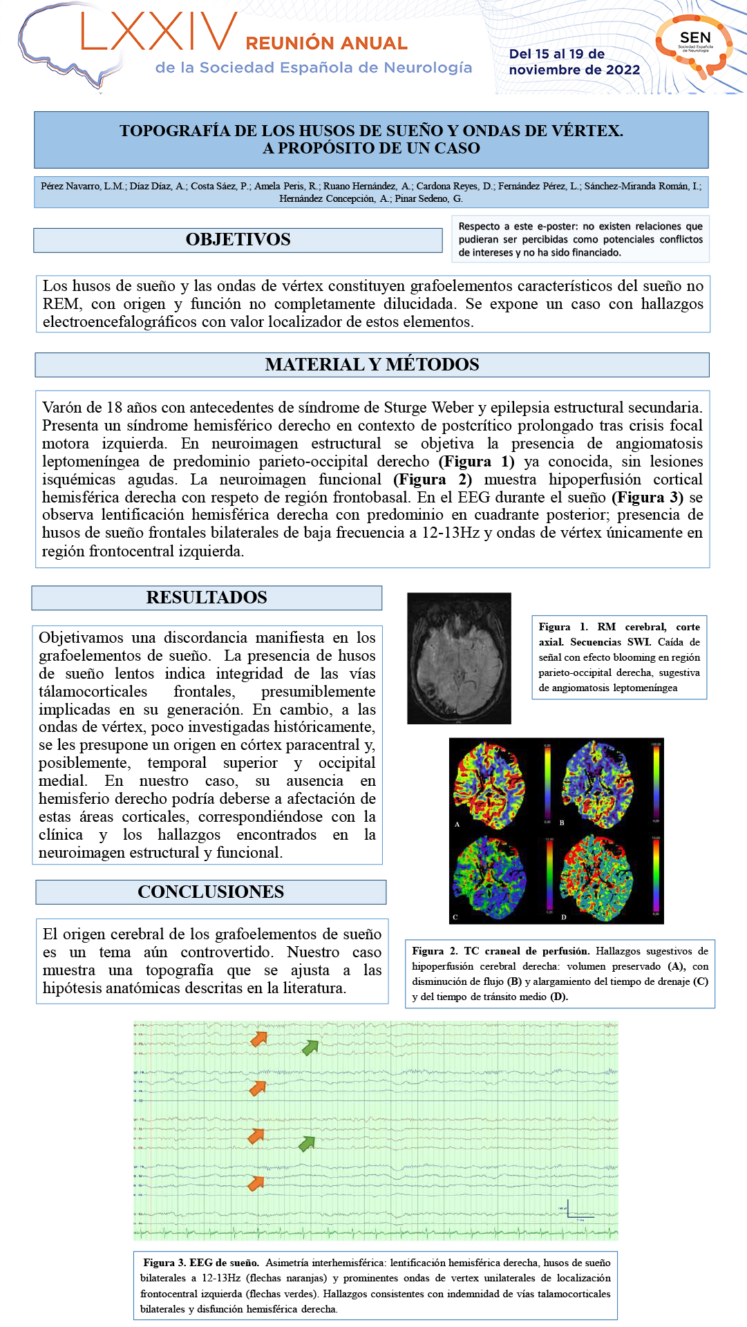Topografía de los husos de sueño y ondas de vértex. A propósito de un caso