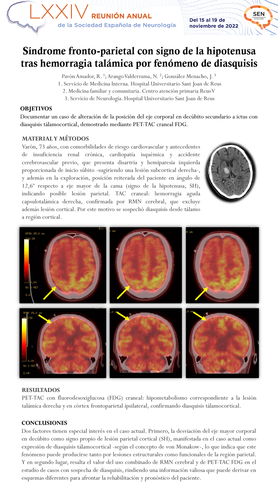 Síndrome fronto-parietal con signo de la hipotenusa tras hemorragia talámica por fenómeno de diasquisis