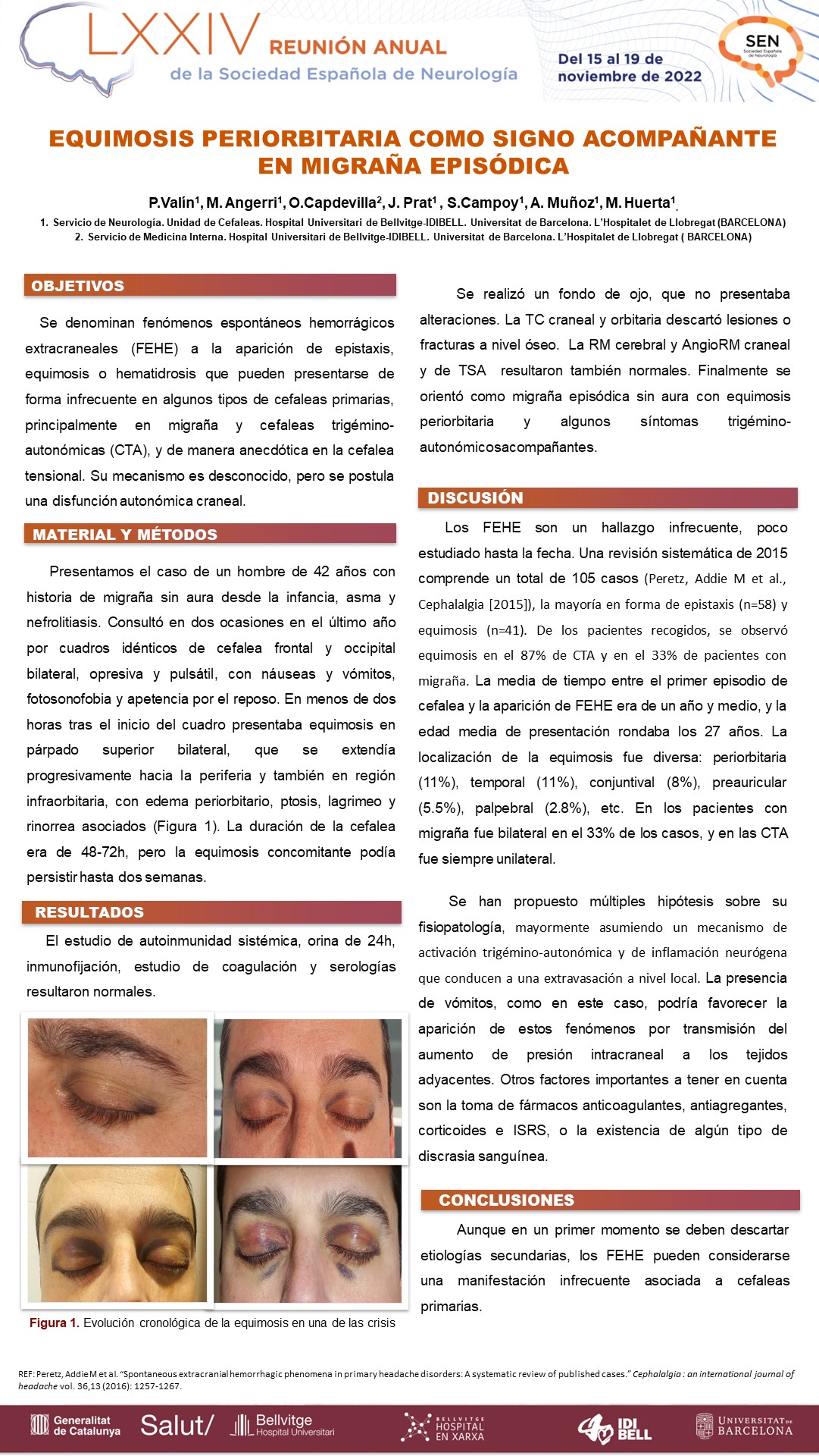 Equimosis periorbitaria como signo acompañante en migraña episódica