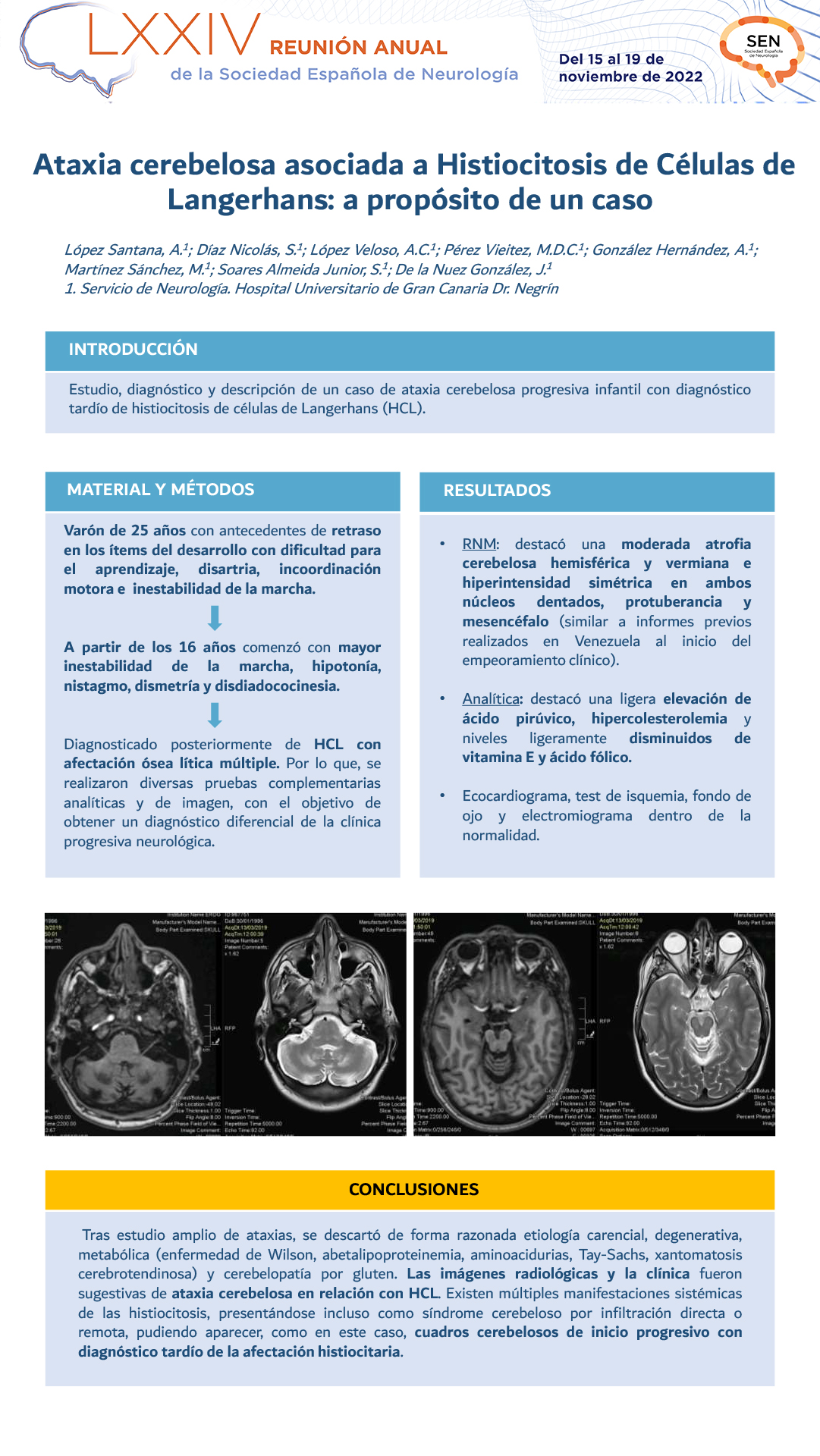 Ataxia cerebelosa asociada a histiocitosis de células de langerhans: a propósito de un caso