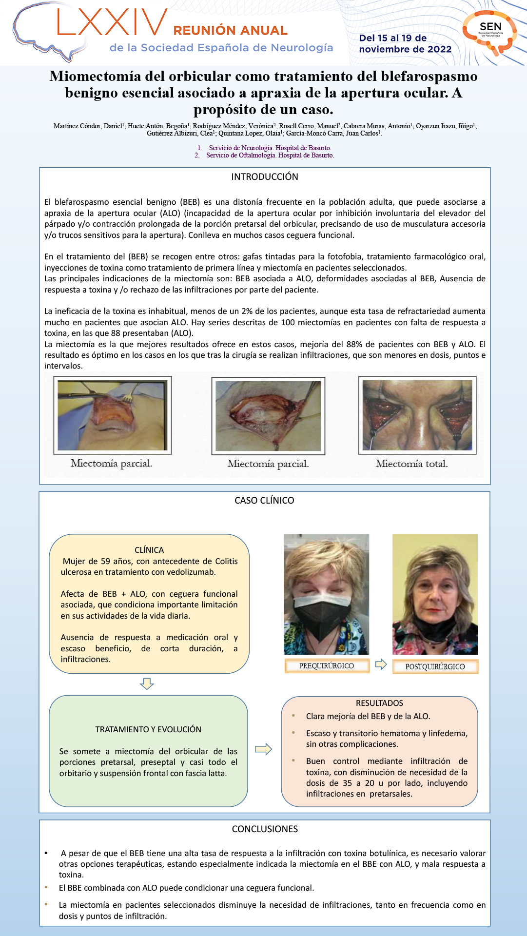 Miomectomía del orbicular como tratamiento del blefarospasmo beningno esencial asociado a apraxia de la apertura ocular. A propósito de un caso