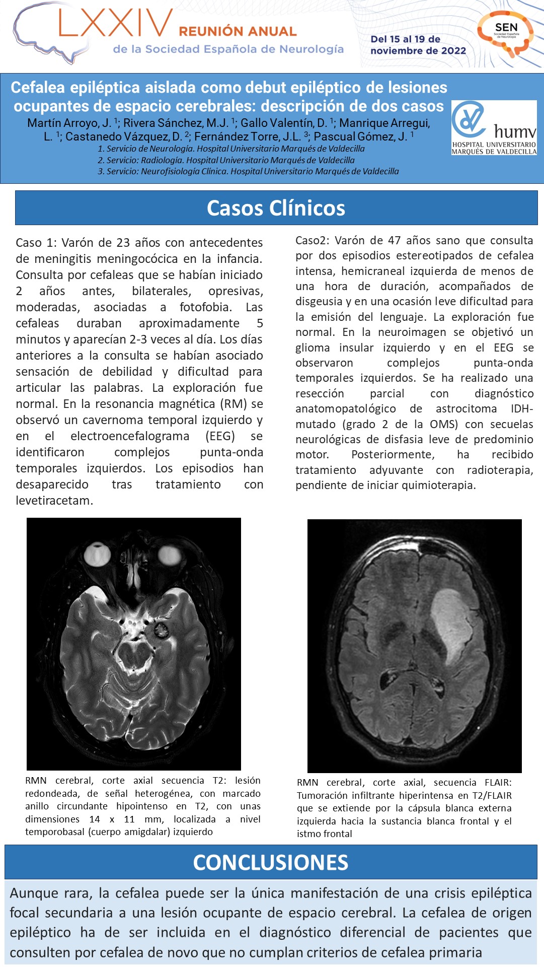 Cefalea epiléptica aislada como debut de lesiones ocupantes de espacio cerebrales: descripción de dos casos