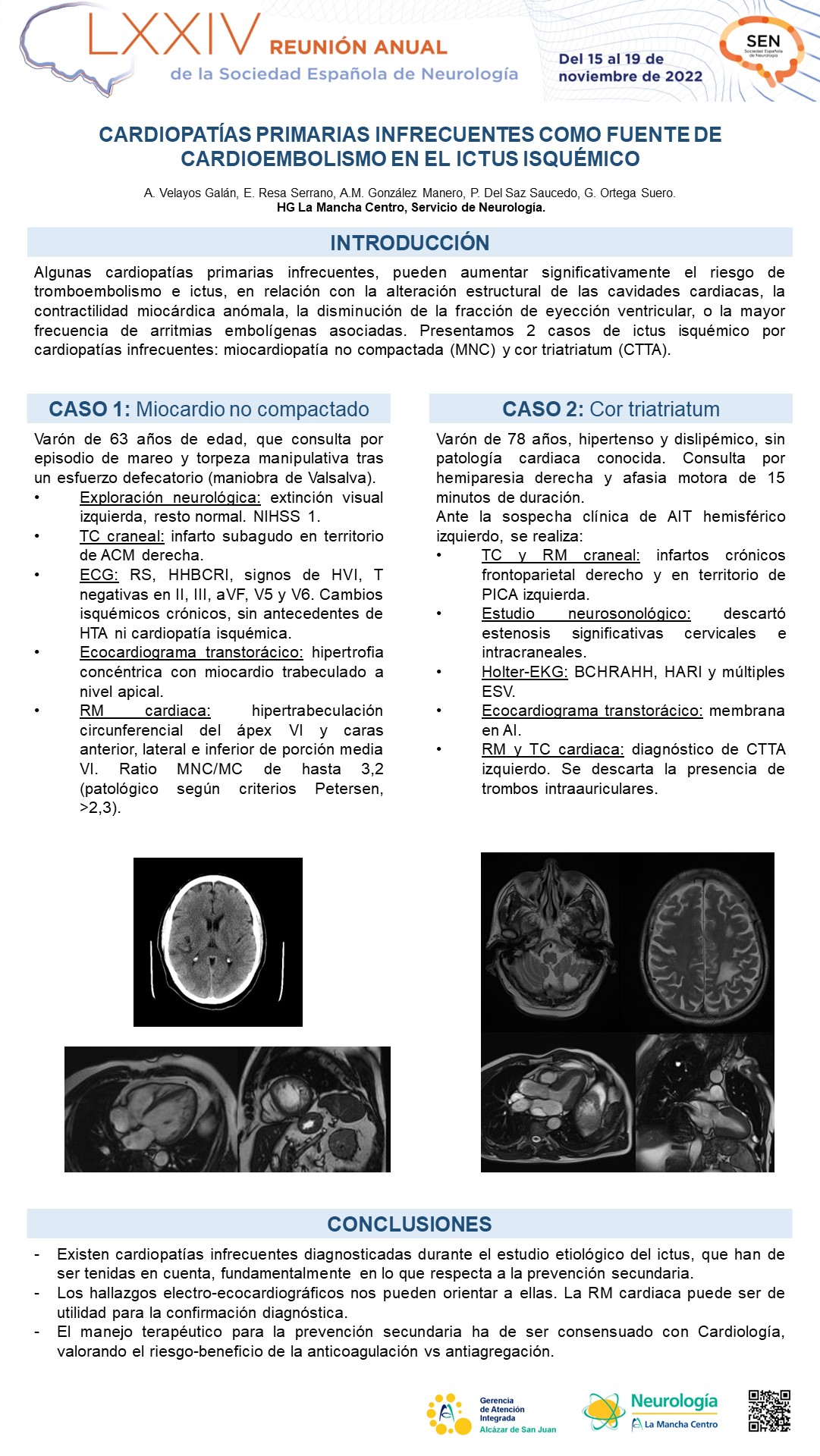 Cardiopatías primarias infrecuentes como fuente de cardioembolismo en el ictus isquémico