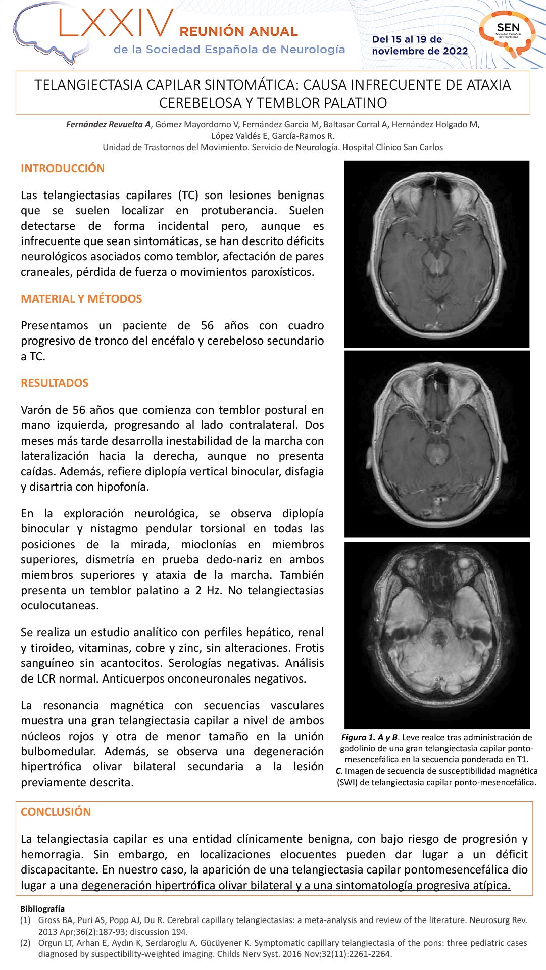 Telangiectasia capilar sintomática: causa infrecuente de ataxia cerebelosa y temblor palatino