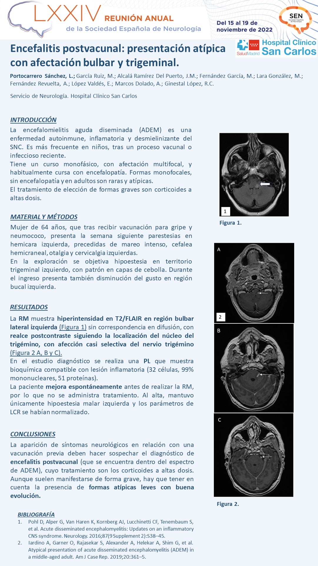 Encefalitis postvacunal: presentación atípica con afectación bulbar y trigeminal