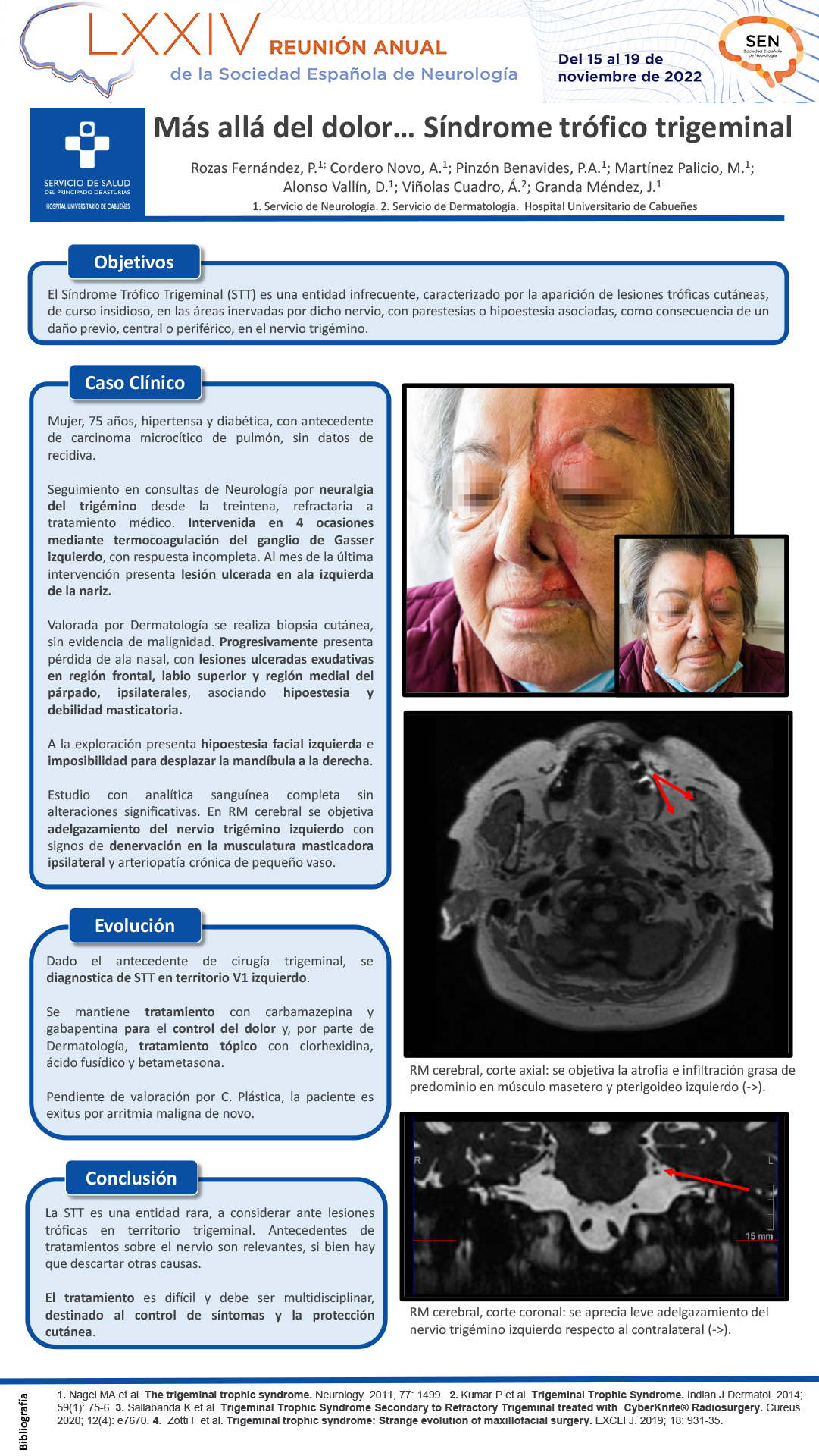 Más allá del dolor… Síndrome trófico trigeminal