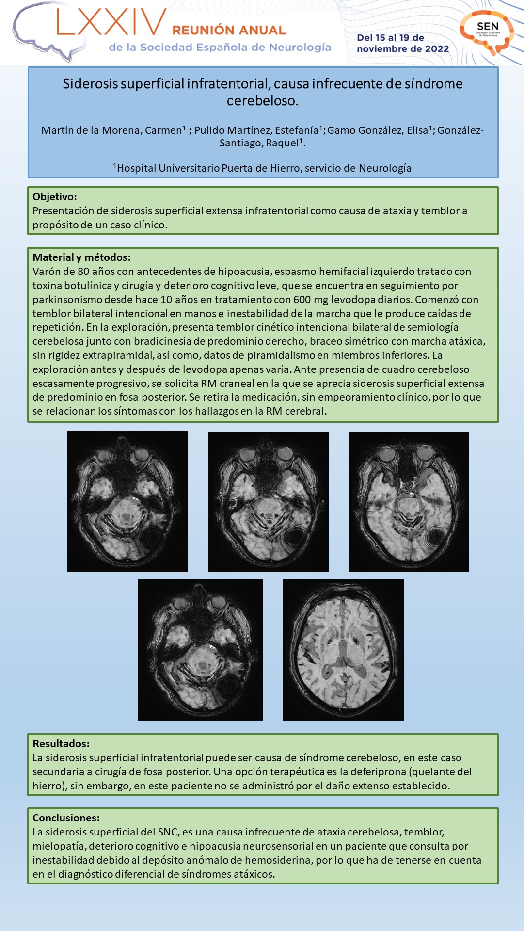 Siderosis superficial infratentorial, causa infrecuente de síndrome cerebeloso