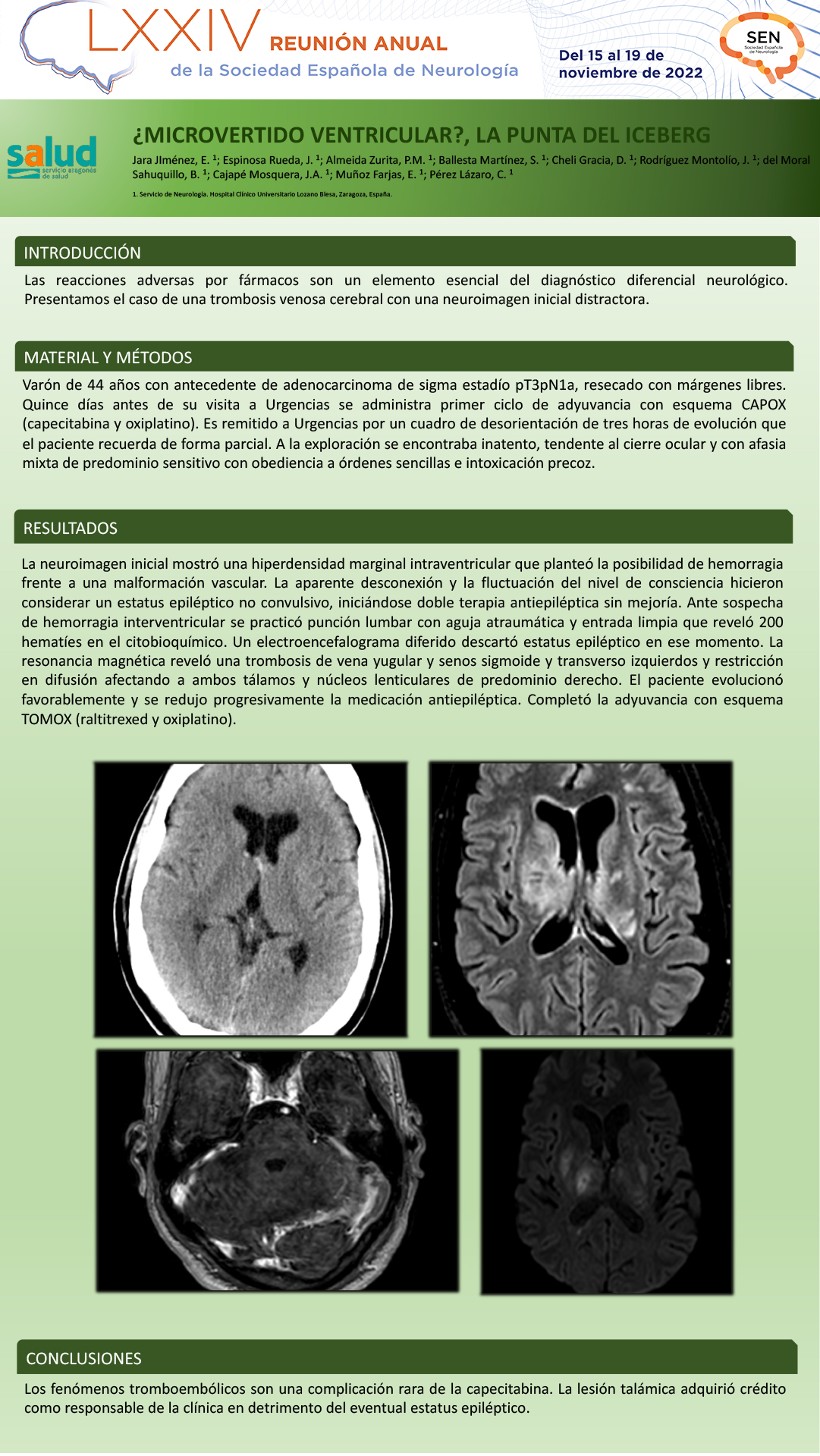 Microvertido ventricular: la punta del iceberg de un infarto talámico bilateral secundario a trombosis venosa cerebral en contexto de quimioterapia con capecitabina