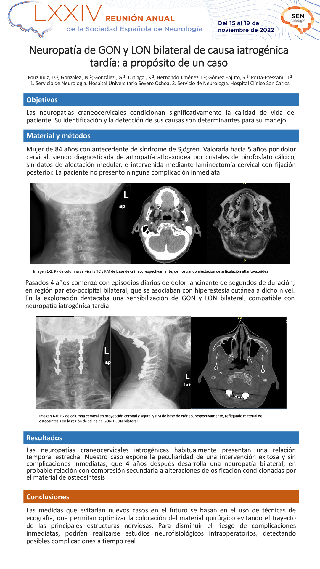 Neuropatía de GON y LON bilateral de causa iatrogénica tardía: a propósito de un caso
