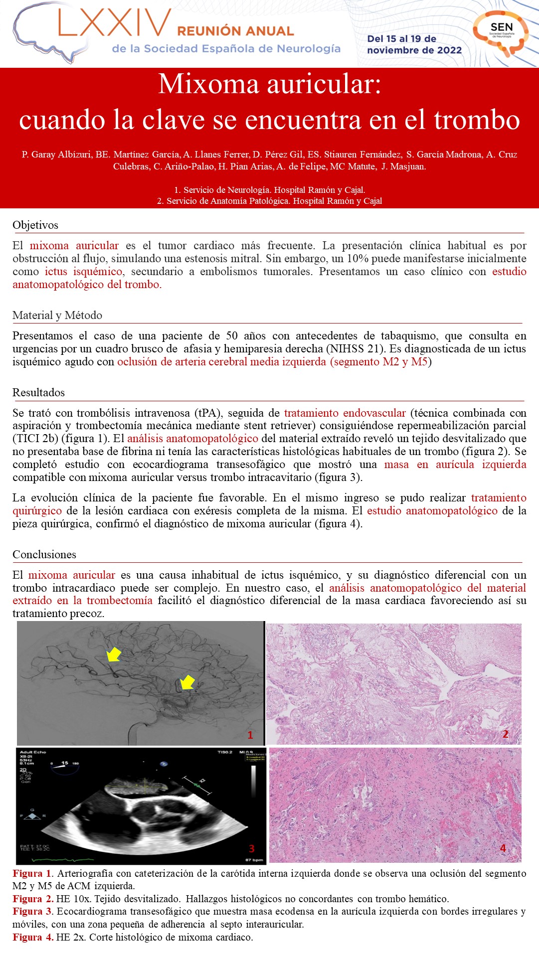 Mixoma auricular: cuando la clave se encuentra en el trombo