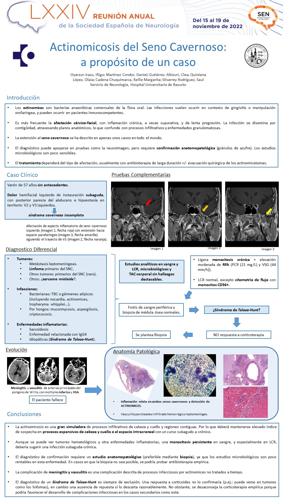 Actinomicosis del Seno Cavernoso: a raíz de un caso