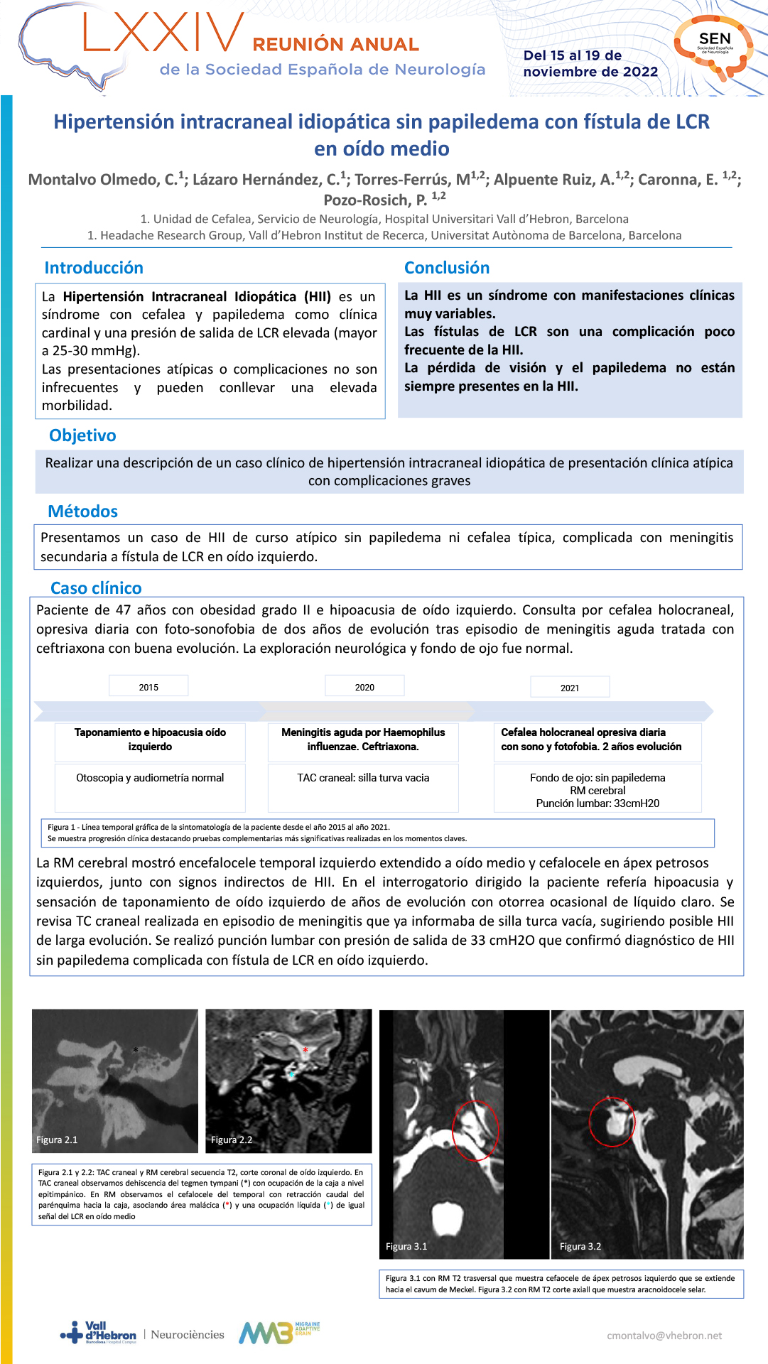 Hipertensión intracraneal idiopática sin papiledema  con fístula de LCR en oído medio