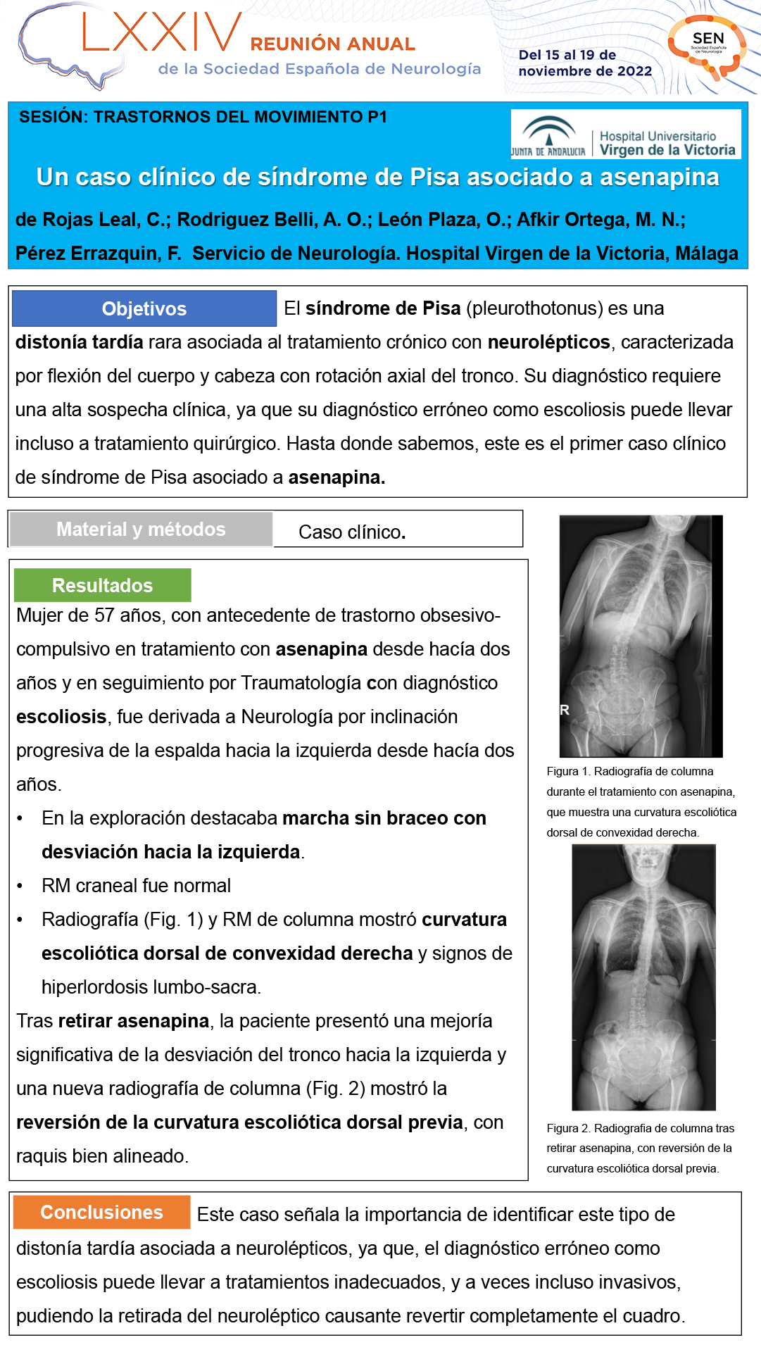 Un caso clínico de síndrome de Pisa asociado a asenapina