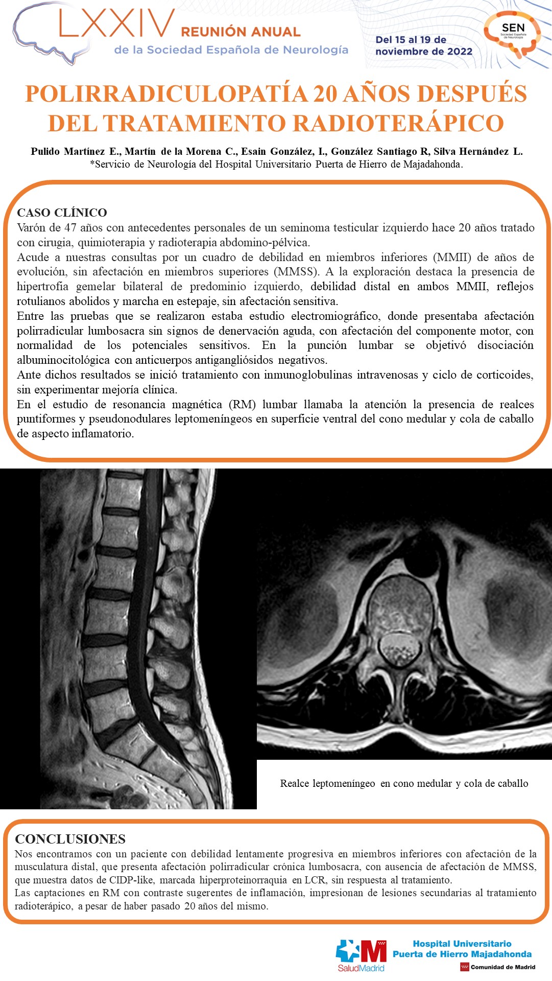 Polirradiculoplexopatía tras más de 20 años desde el tratamiento radioterápico