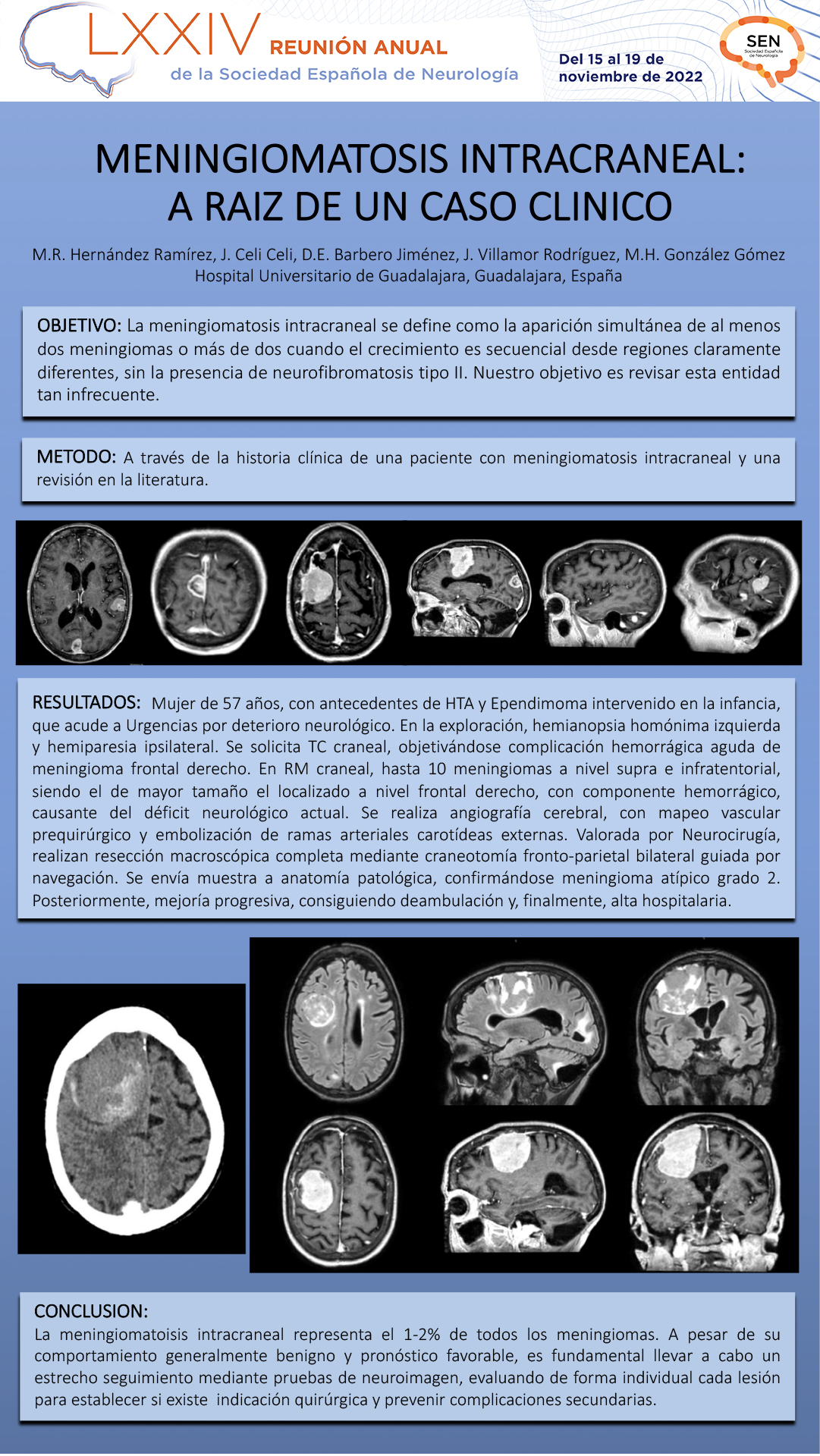 MeningiomatosiS intracraneal; a raíz de un caso clínico