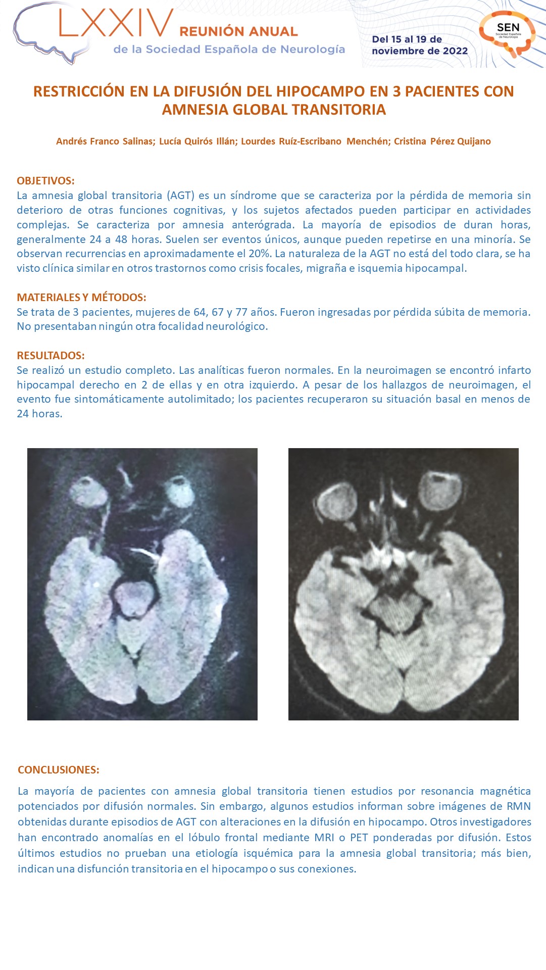 Restricción en la difusión del hipocampo en 3 pacientes con amnesia global transitoria