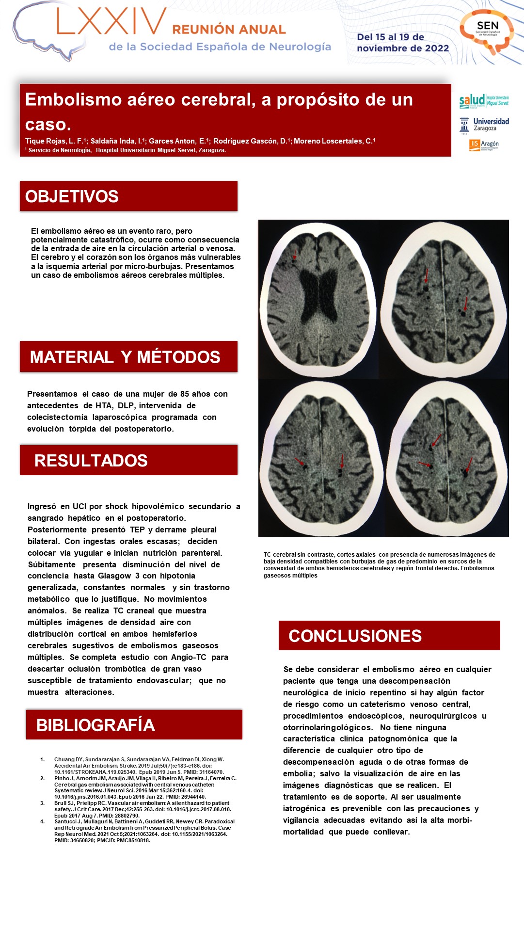 Embolismo aéreo cerebral, a propósito de un caso