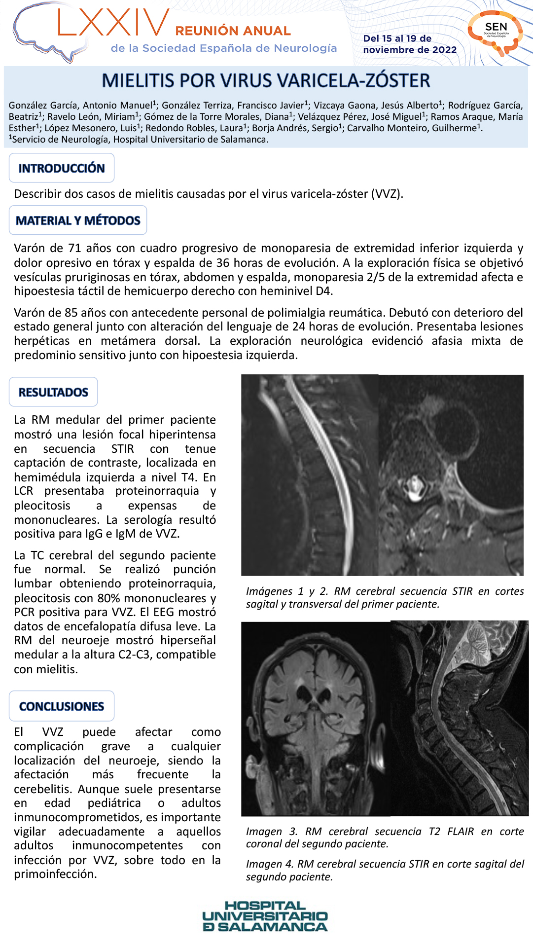 Mielitis por virus varicela-zóster