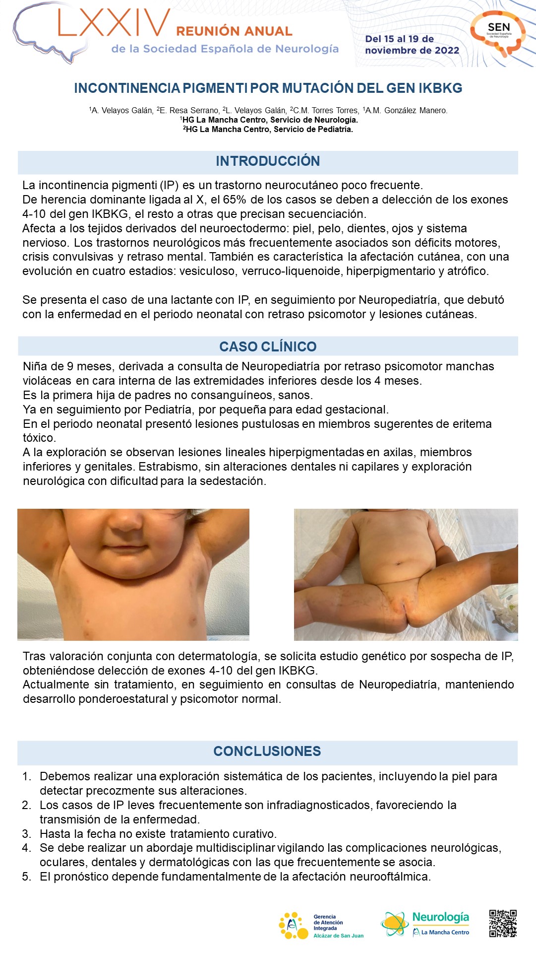 Incontinencia pigmenti por mutación del gen IKBKG