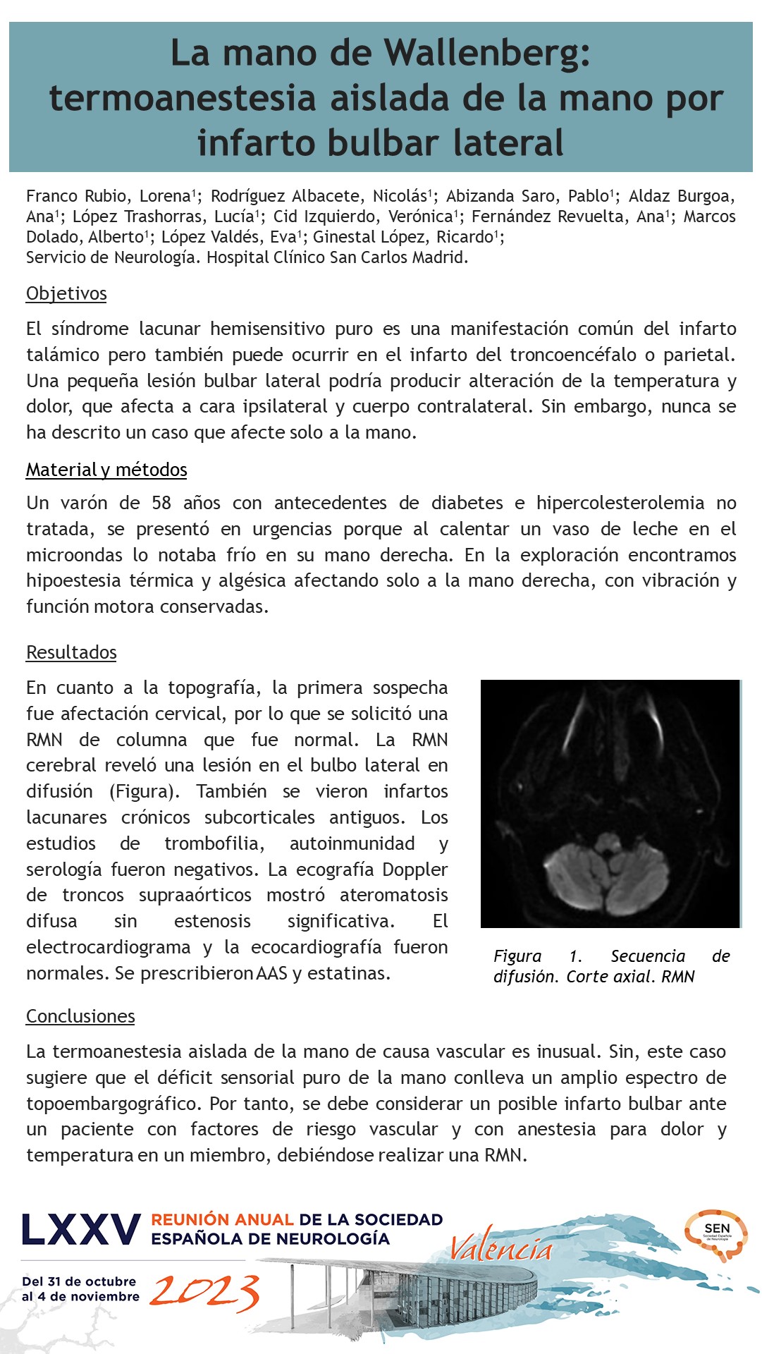 La mano de Wallenberg: termoanestesia aislada de la mano por infarto bulbar lateral