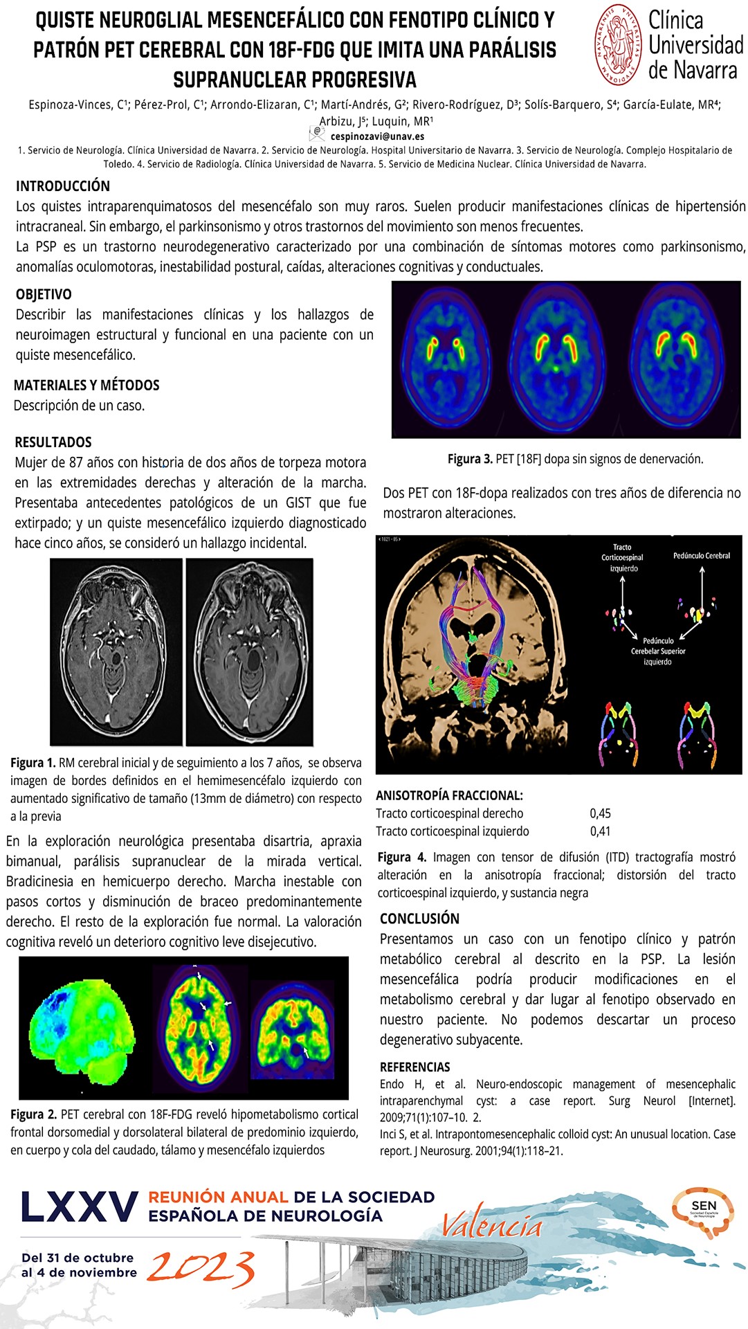 Quiste neuroglial mesencefálico con fenotipo clínico y patrón PET cerebral con 18F-FDG que imita una parálisis supranuclear progresiva
