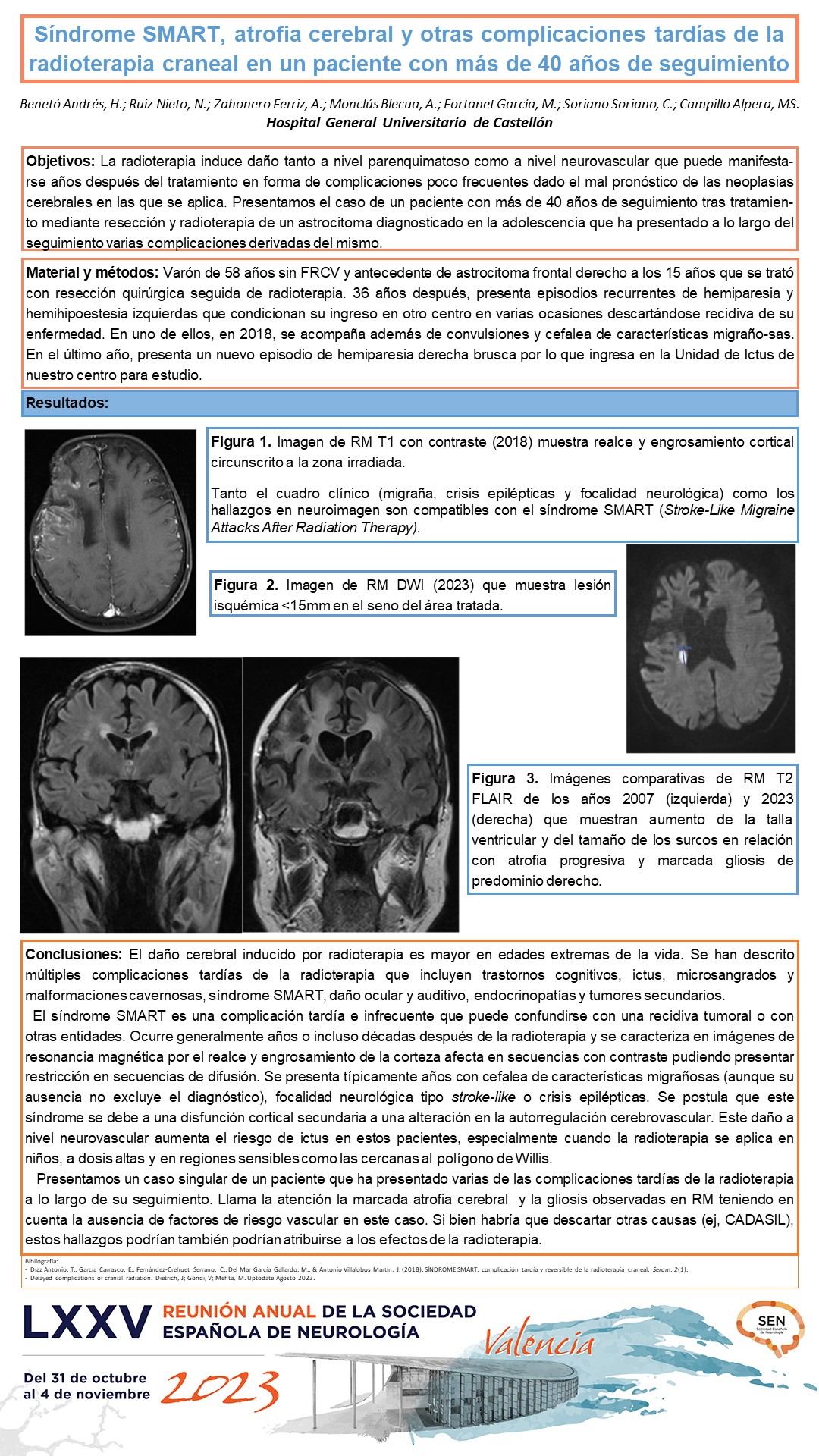 Síndrome SMART, atrofia cerebral y otras complicaciones tardías de la radioterapia craneal en un paciente con más de 40 años de seguimiento